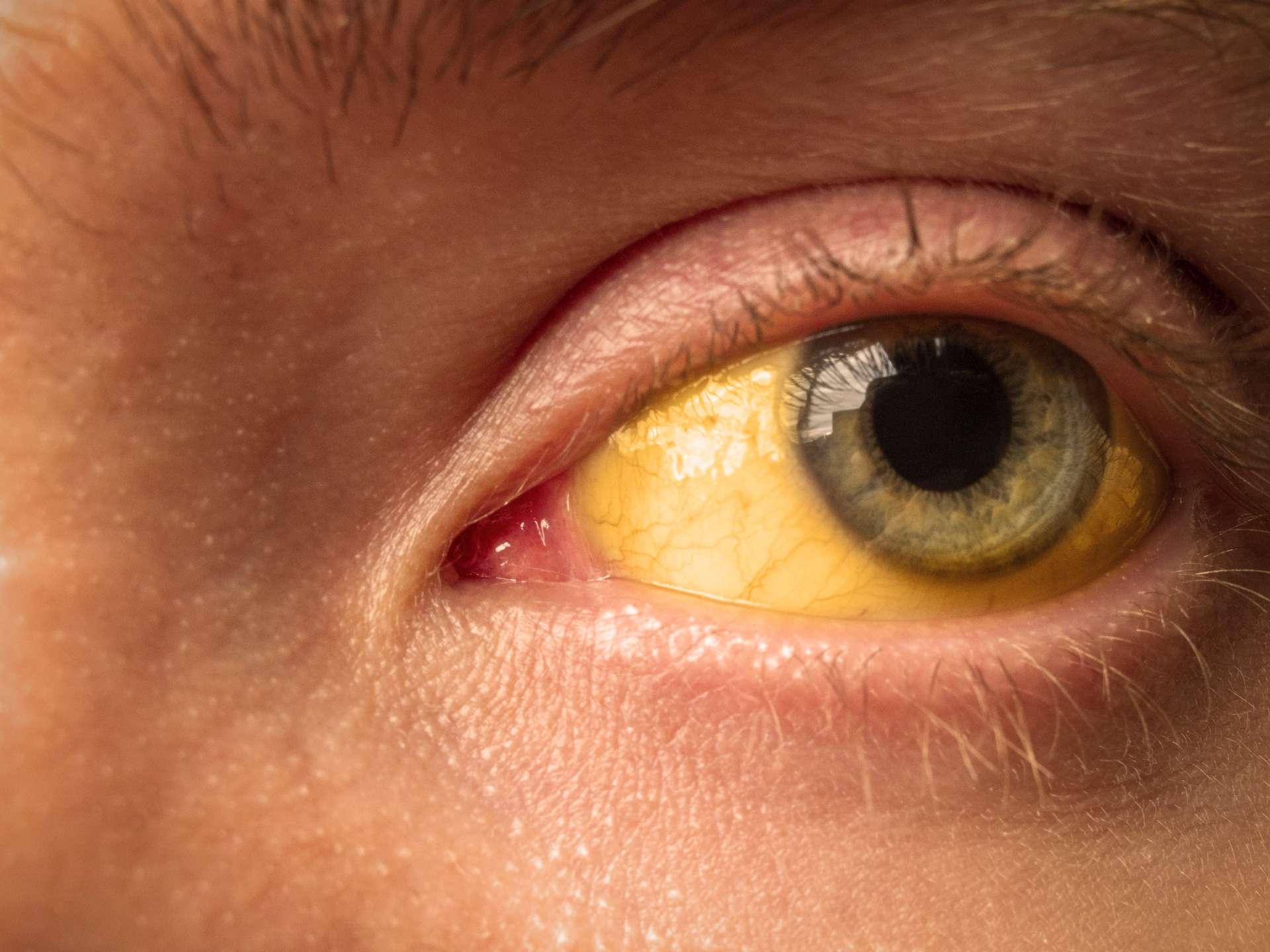 Gelbfärbung der Sklera des Auges bei Erkrankungen der Leber, Zirrhose, Hepatitis, Bilirubin