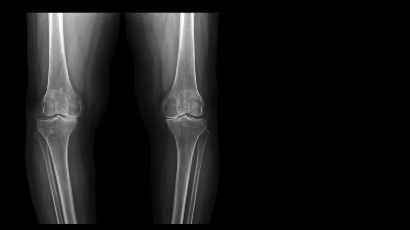 mediales Kompartiment OA Knieerkrankung