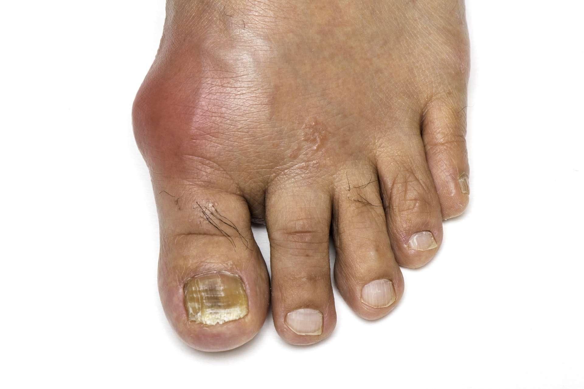 Fuß mit Gicht und Pilz-Zehennagel infiziert