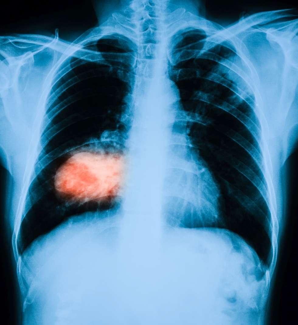 Das Röntgenbild der Brust, PA-Ansicht von oben, zeigt eine riesige isolierte Masse in der rechten Lunge.