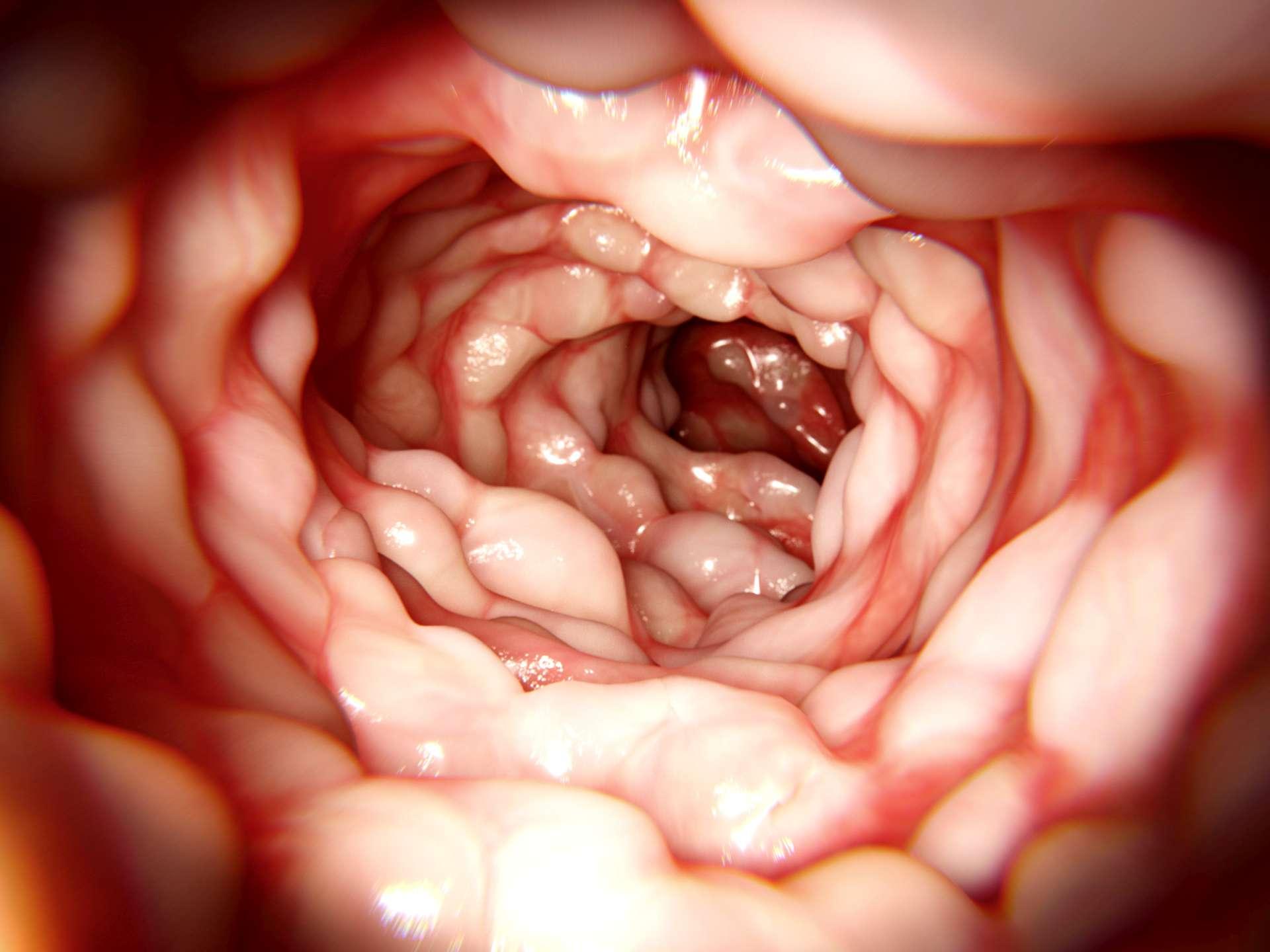 Morbus Crohn ist eine entzündliche Darmerkrankung, die Bauchschmerzen, Durchfall und Erbrechen verursacht.