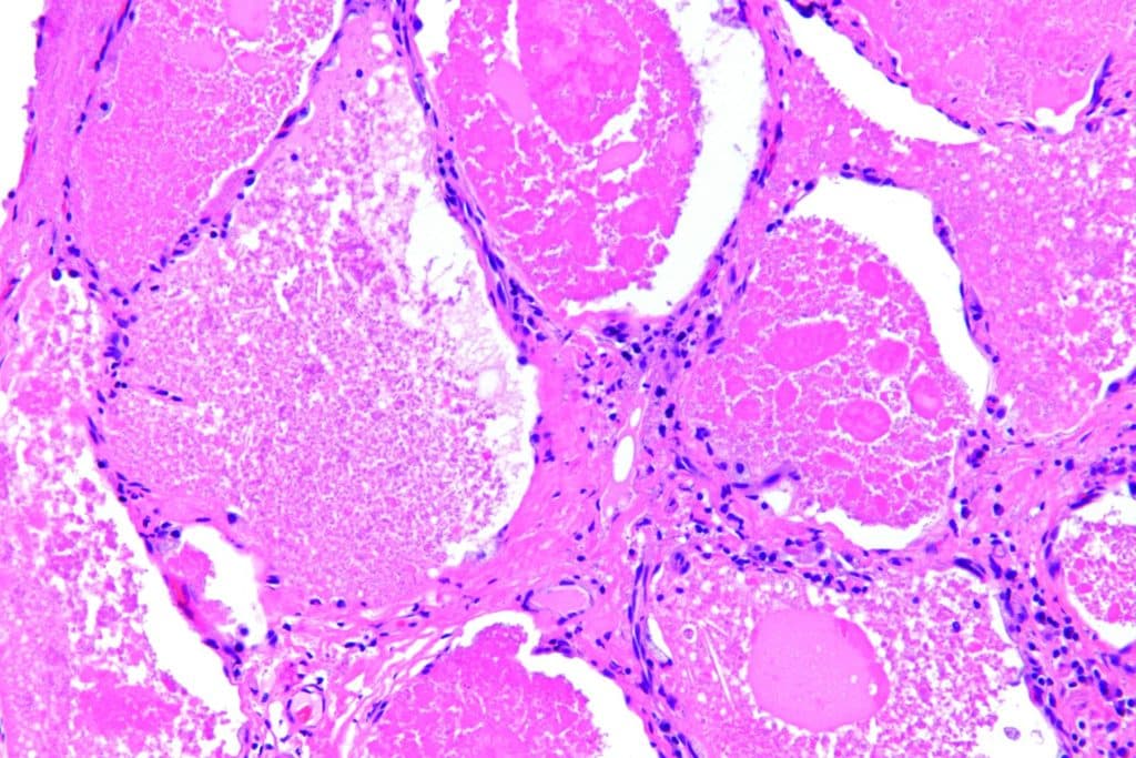 MT_CH_2020_KW45_MTCH_Pneumo_2020_03_S03Pulmonary_alveolar_proteinosis_-3-_high_mag.jpg