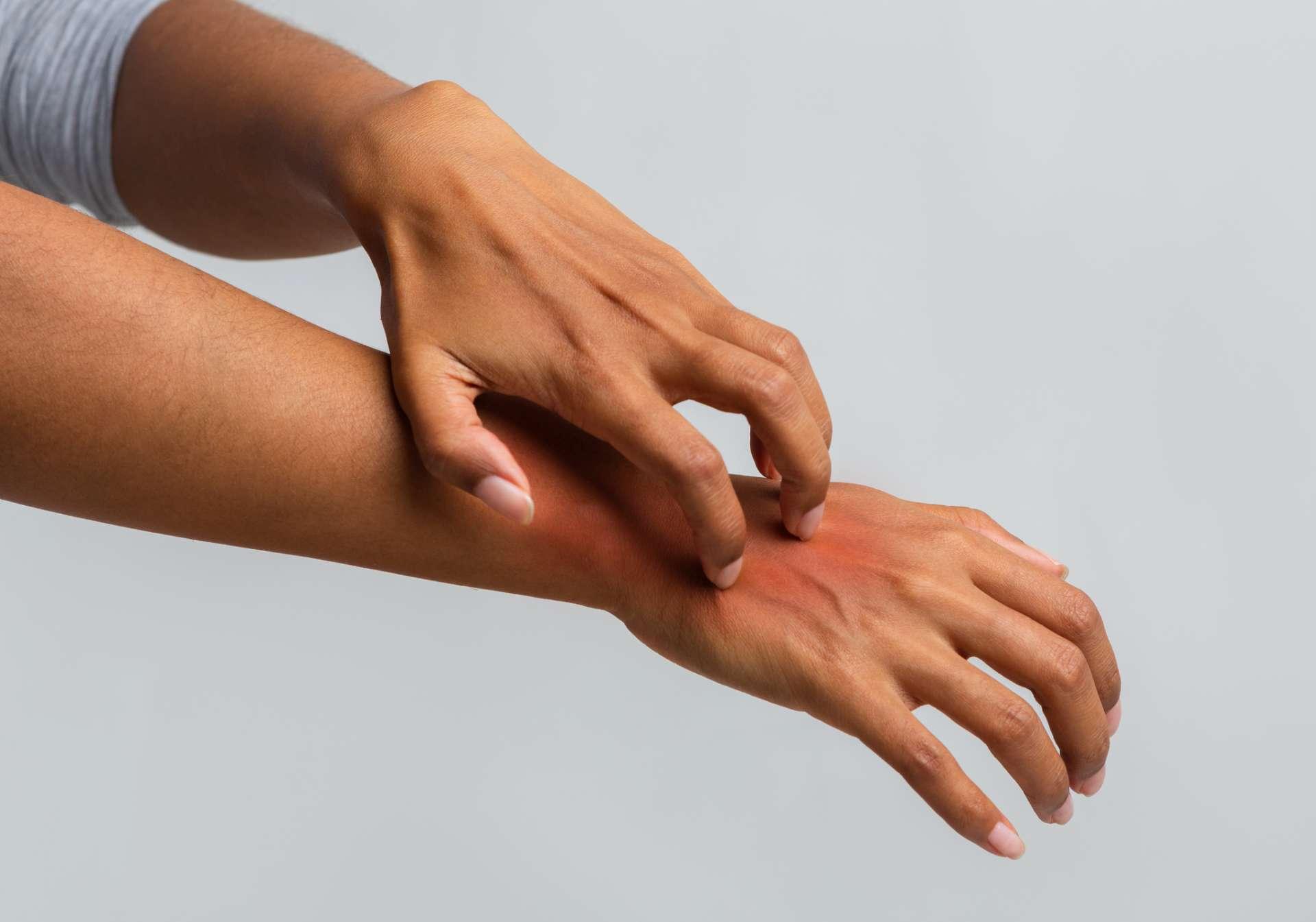 Beschnitten von einer Afro-Frau, die ihre Hand kratzt und an Psoriasis leidet, grauer Hintergrund