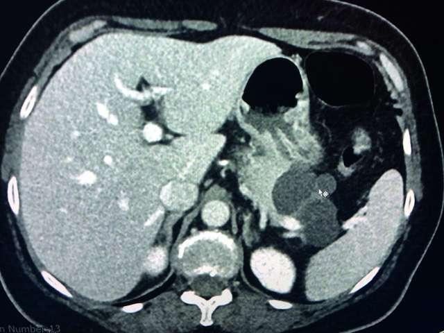 Pankreastumore 2 - Zystische Neoplasien des Pankreas