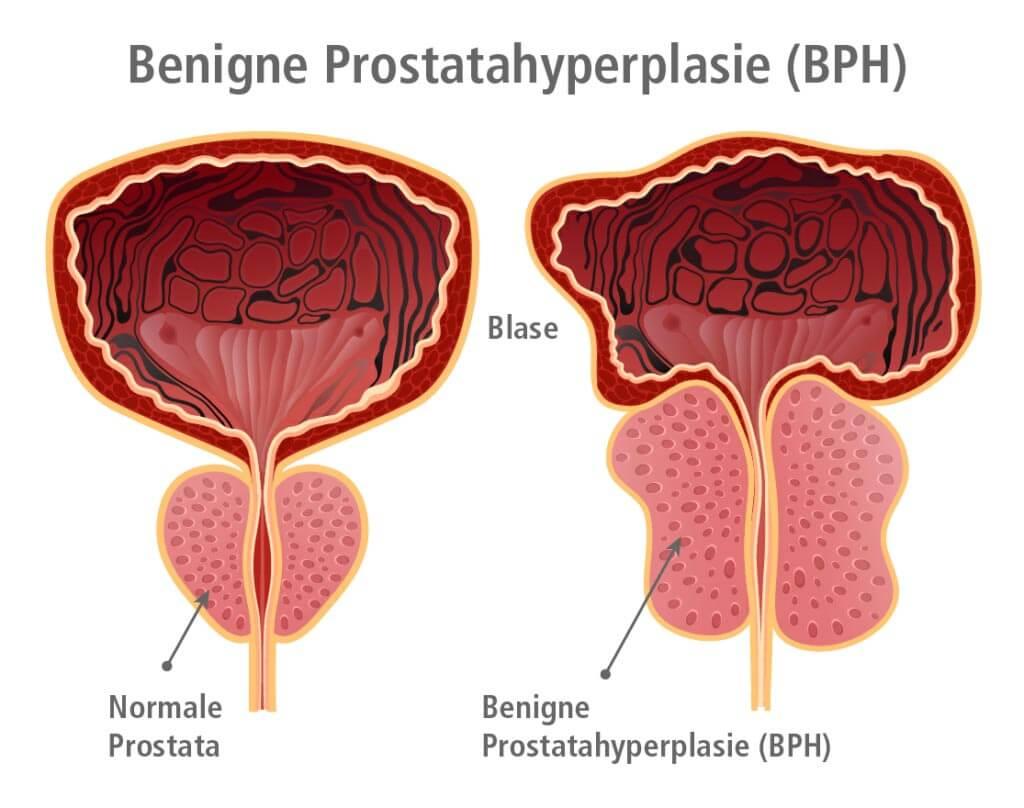 Illustration einer Prostata