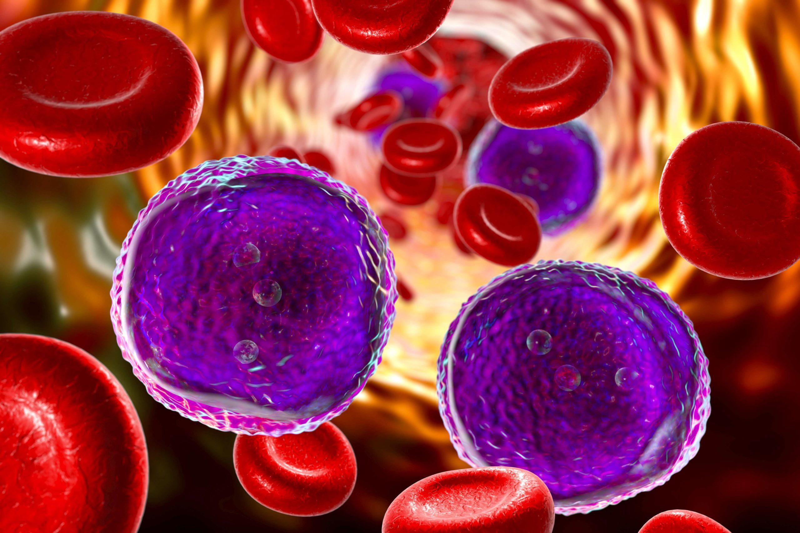 Akute lymphoblastische Leukämie, 3D-Darstellung mit reichlich Lymphoblasten im Blut