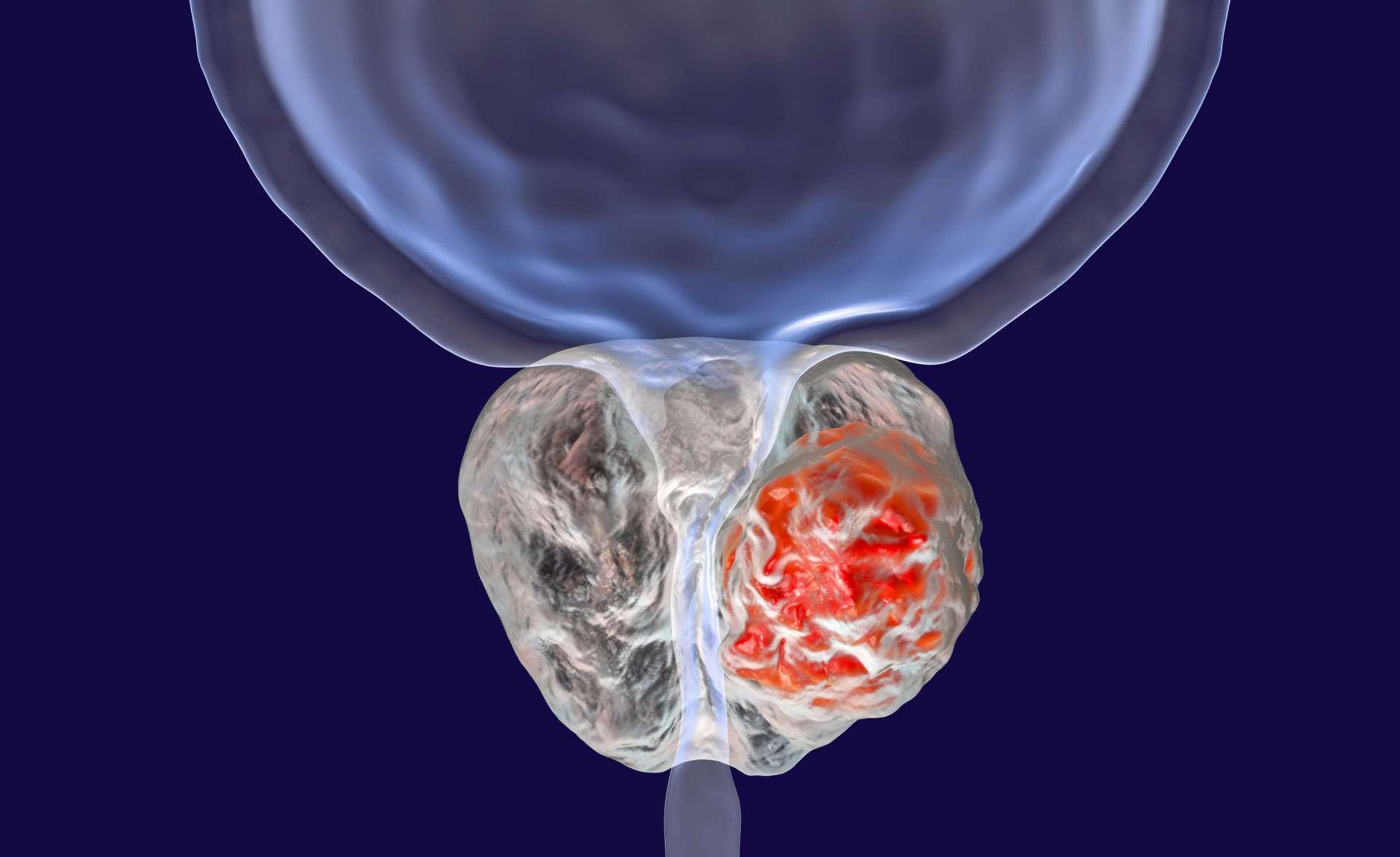 Prostatakrebs, 3D-Darstellung, die das Vorhandensein eines Tumors in der Prostata zeigt, der die Harnröhre komprimiert