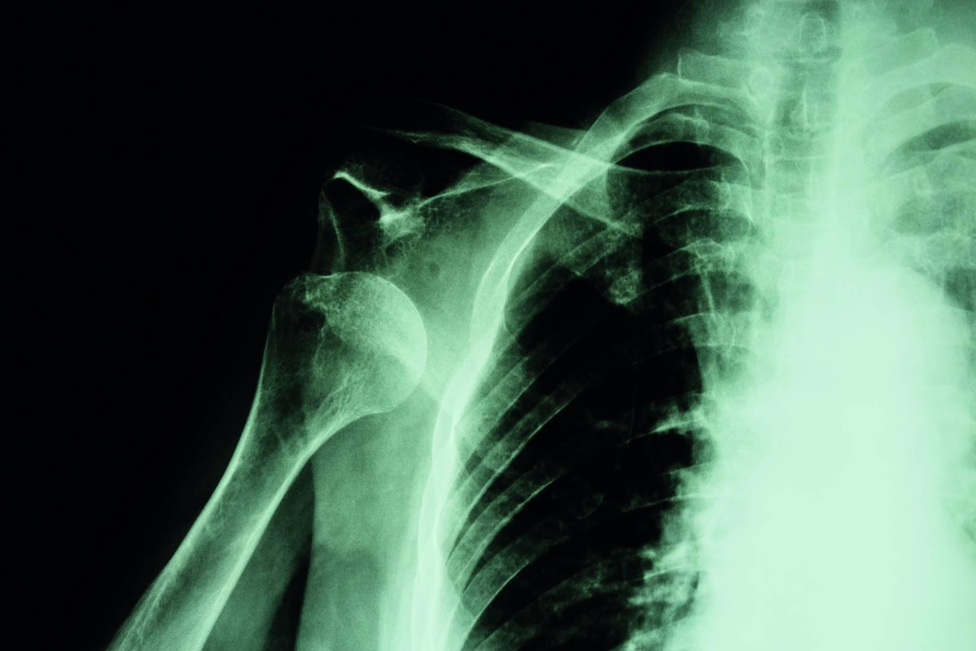 Röntgen der vorderen Schulterluxation