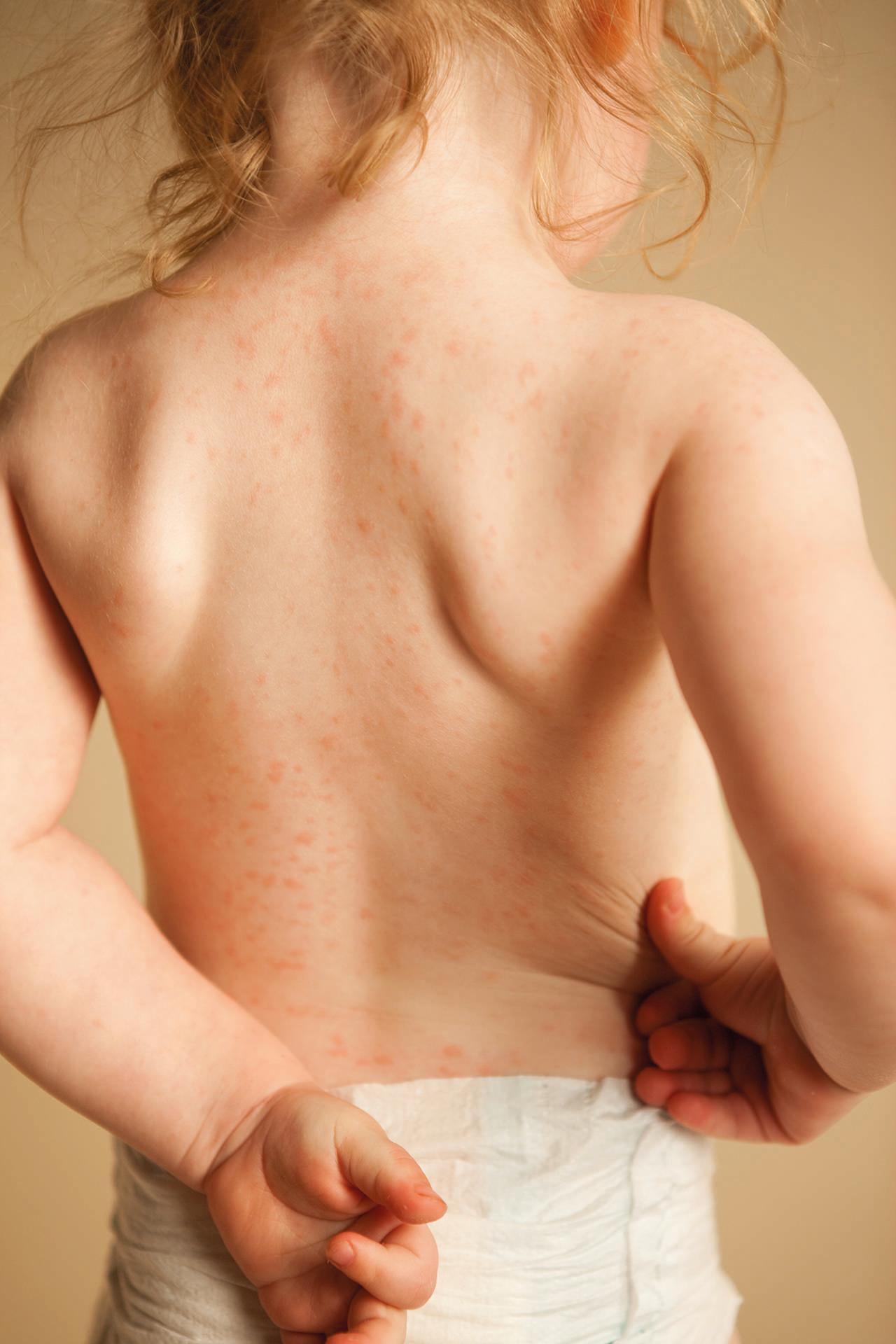 Farbfoto eines zweijährigen Mädchens mit einem Hautausschlag aufgrund einer allergischen Reaktion auf das Antibiotikum Amoxicillin.