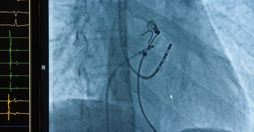 Röntgenaufnahme mit korrekter Platzierung der Katheterablation bei Vorhofflimmern