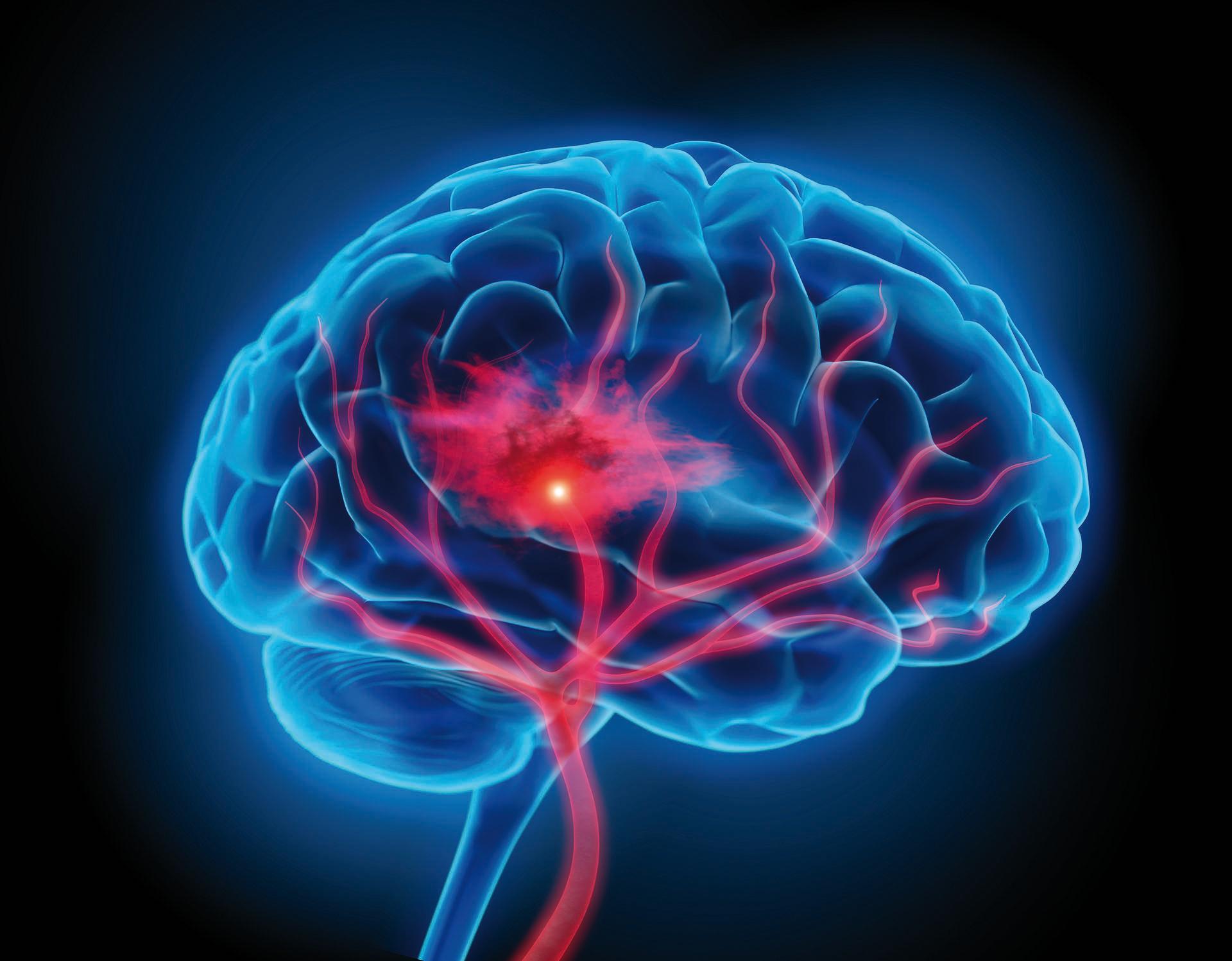Illustration des menschlichen Gehirns mit Schlaganfallsymptom