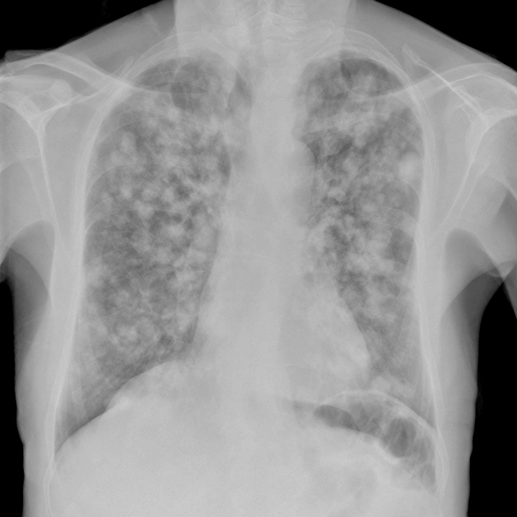 Digitale Röntgenaufnahme mehrerer Lungenmetastasen bei weit verbreitetem Krebs
