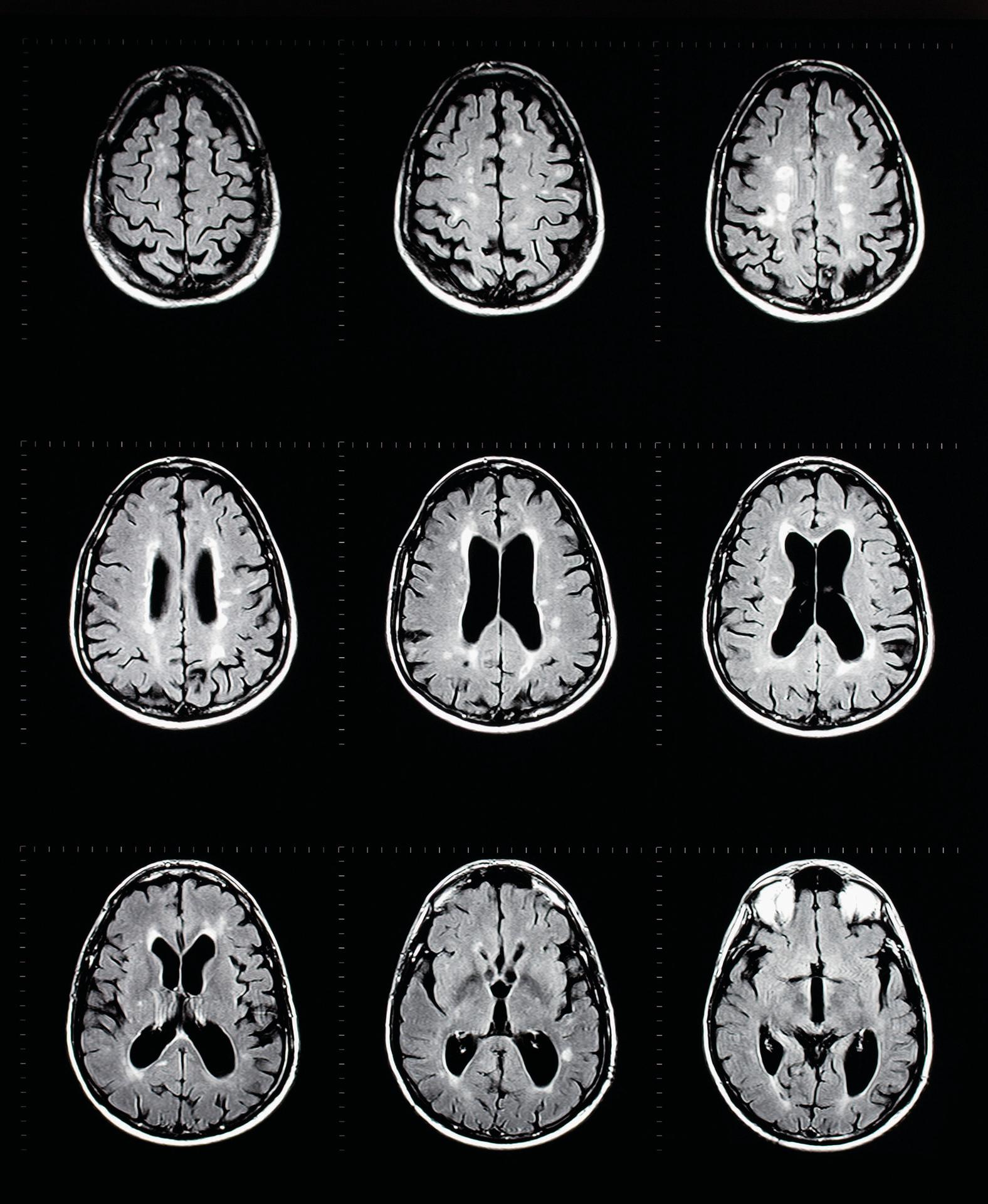 MRT-Untersuchung des menschlichen Gehirns mit Multiple-Sklerose-Plaques