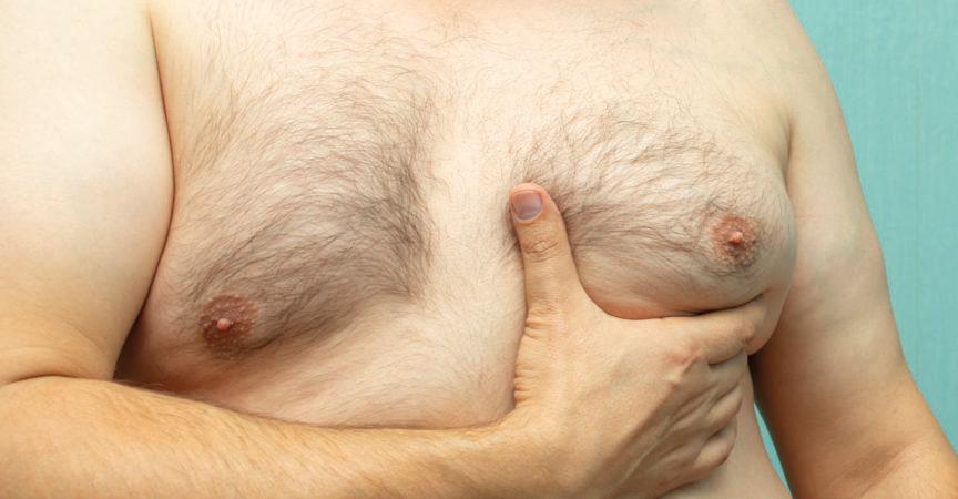 dicker weißer Mann mittleren Alters mit Gynäkomastie, vergrößerter Brust