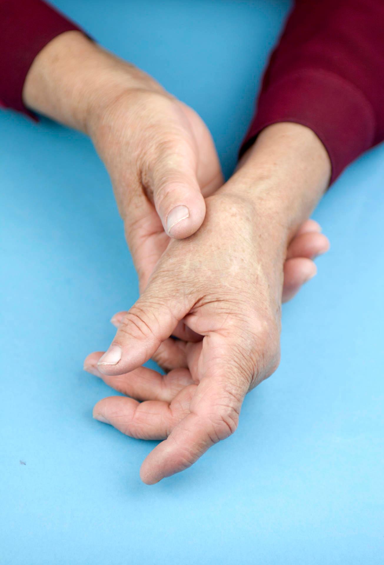 Hände einer Frau, die an rheumatoider Arthritis verformt ist