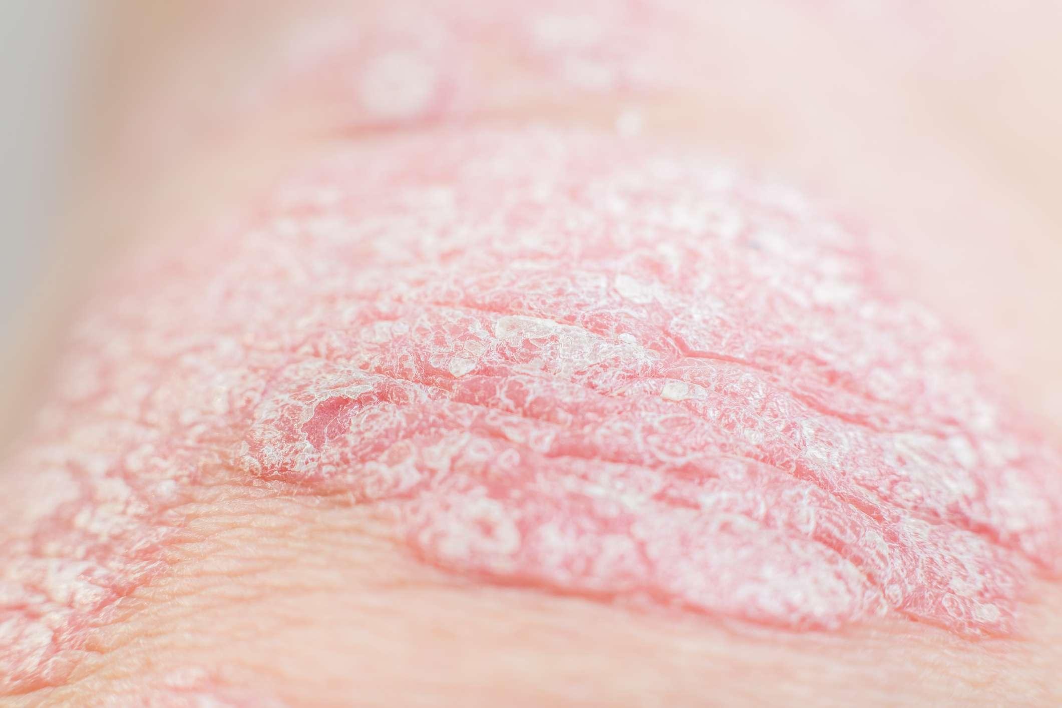 Nahaufnahme akute Psoriasis ist eine unheilbare dermatologische Autoimmunerkrankung der Haut. Großer roter, entzündeter, schuppiger Hautausschlag.Selektiver Fokus