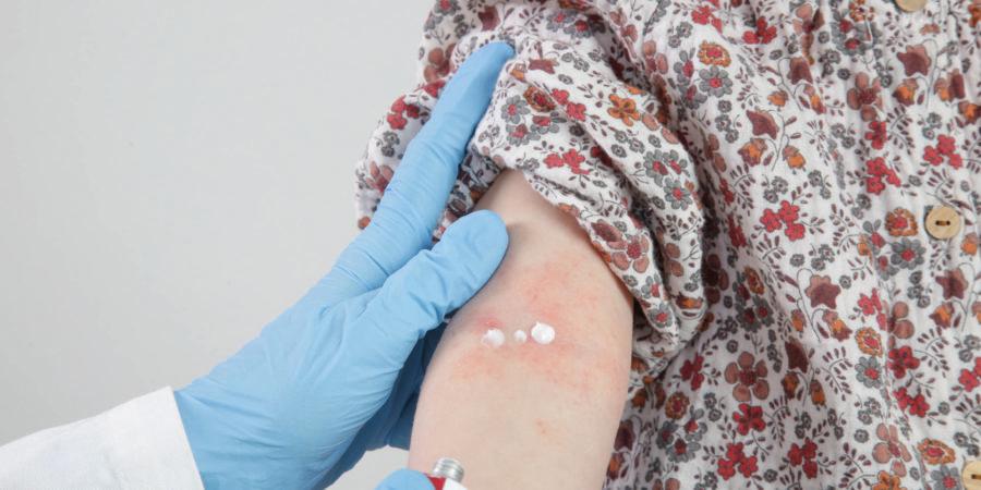 Arzt trägt Salbe auf rotes und juckendes Ekzem am Arm des Kindes auf. Kleinkindmädchen, das an atopischer Dermatitis leidet, Nahaufnahme Bild.