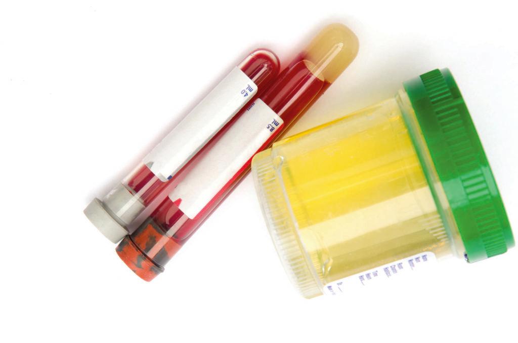 Sterile Urinprobe mit einem gefüllten Glas und einem mit intaktem sterilem Etikett