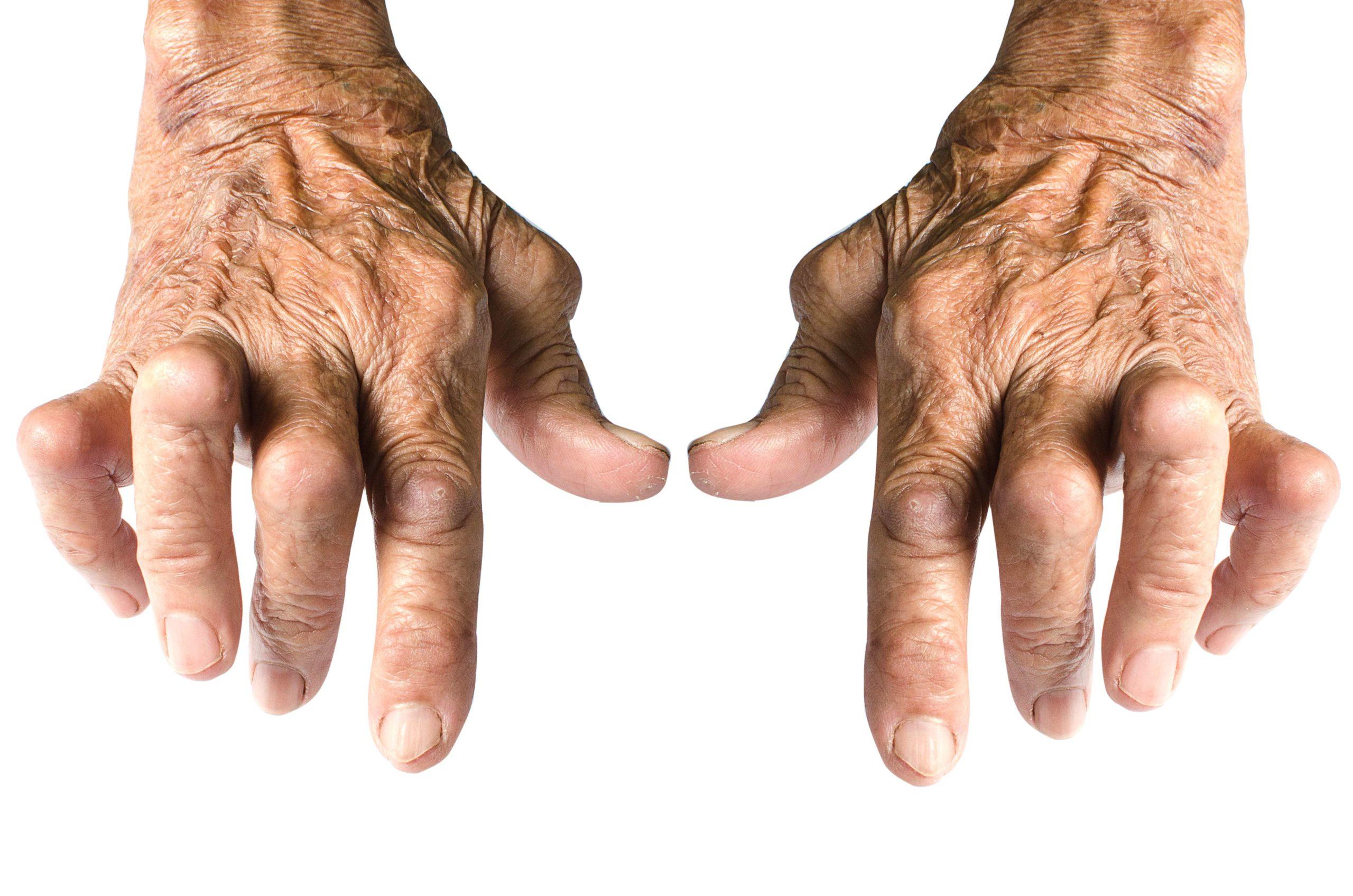 Alte Frauenhände deformiert von rheumatoider Arthritis isoliert auf weißem Hintergrund