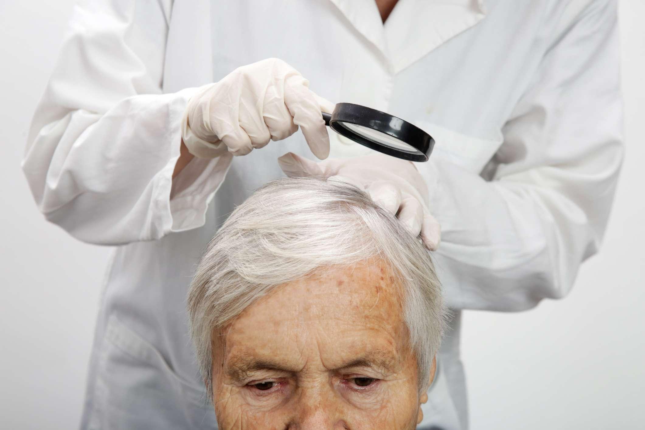 Arzt untersucht die Kopfhaut einer älteren Frau, Kopfhautekzem, Dermatitis, Psoriasis, Haarausfall, Schuppen oder trockene Kopfhaut