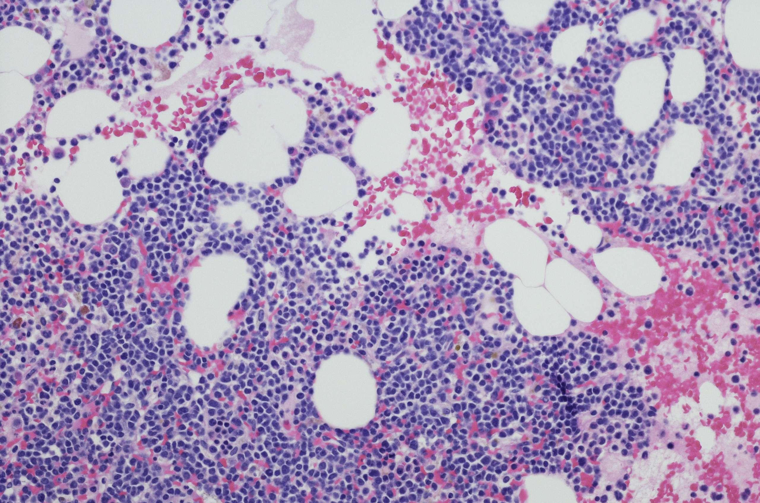 Mikroskopische Aufnahme einer Myelom-Neoplasma-Knochenmarkbiopsie. Hämatoxylin- und Eosin-Färbung