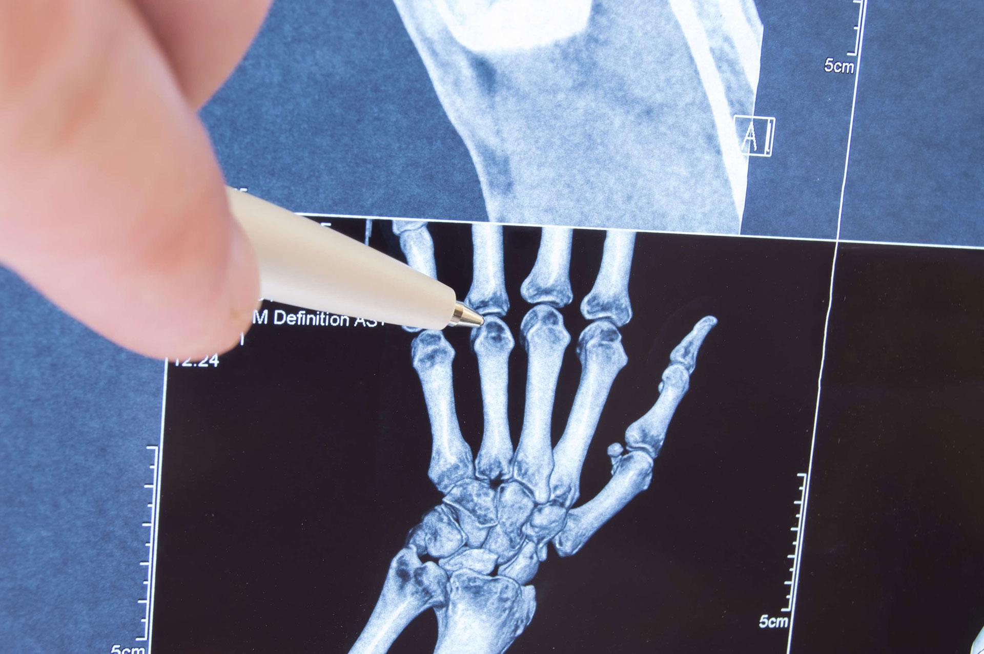 Röntgen eines Handskelett