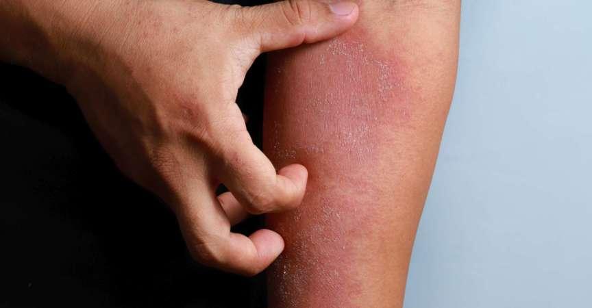 Mann kratzt sich am Arm, medizinische atopische Ekzemallergietextur der kranken menschlichen Haut