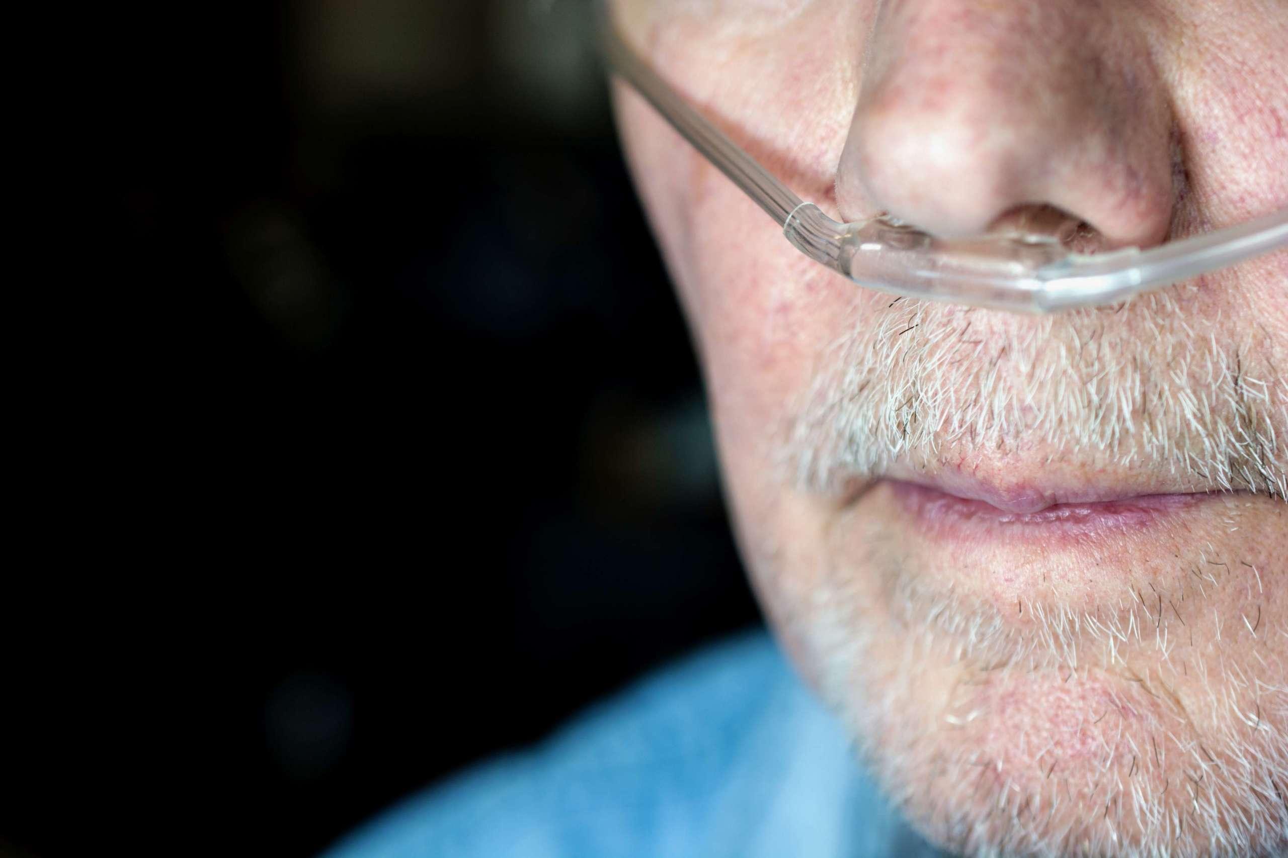 Gesicht eines älteren Mannes mit Sauerstoffkanüle, die Sauerstoff durch die Nasenlöcher einbringt.