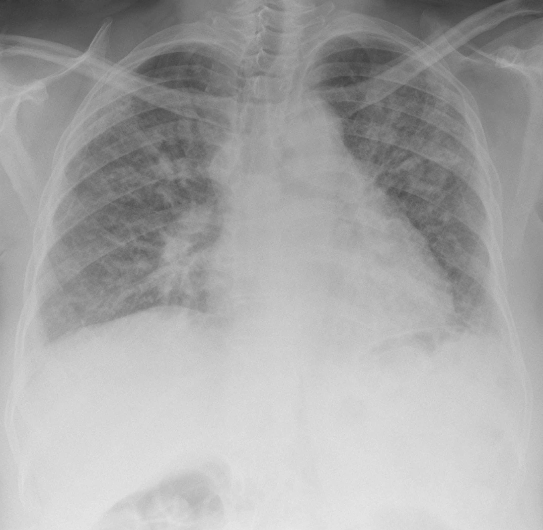 Digitales Röntgenthorax, das ein ausgedehntes retikuläres Muster und ein geschrumpftes Lungenvolumen aufgrund einer schweren Lungenfibrose zeigt.
