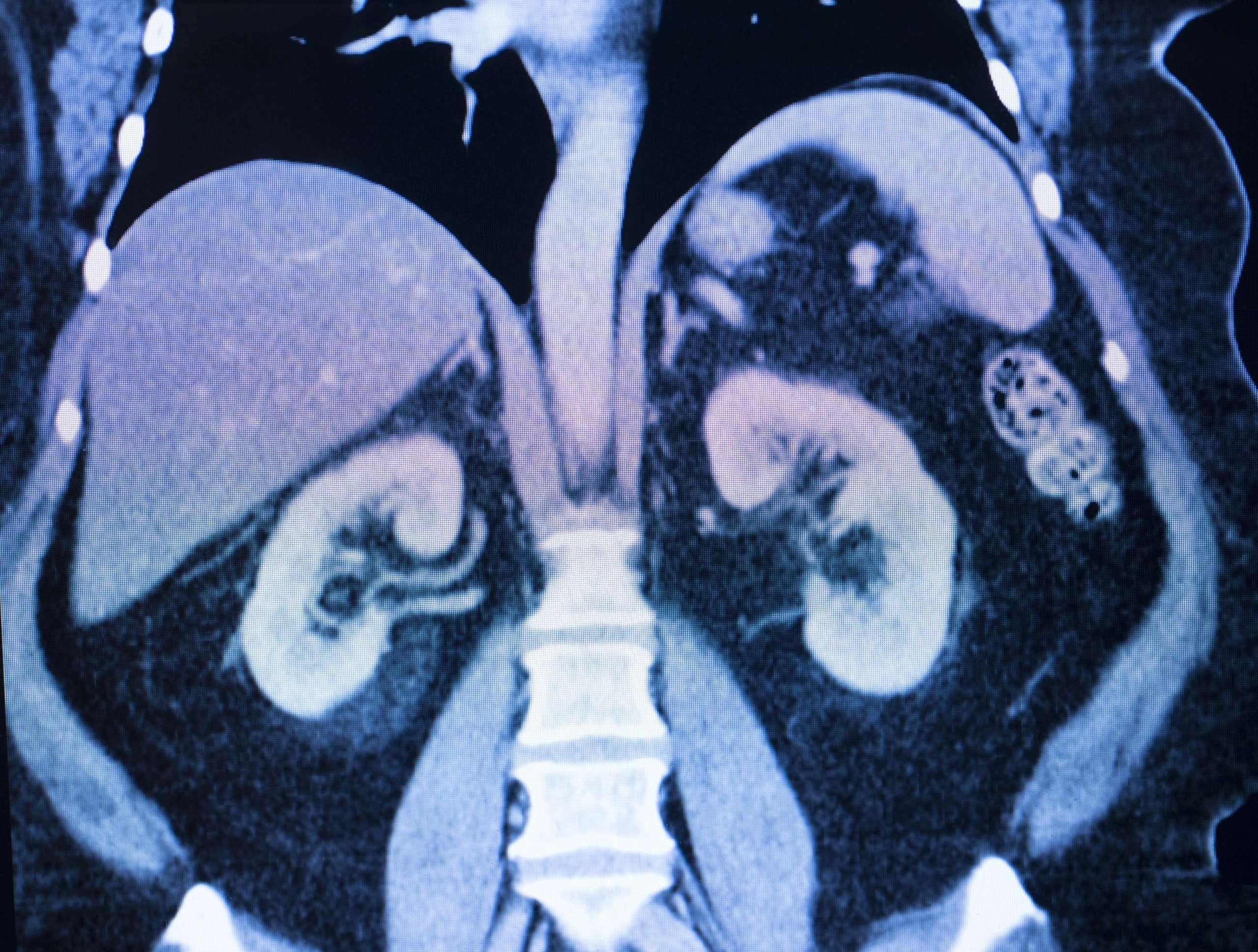 Ein medizinischer MRT-Scan eines weiblichen Körpers. Darstellung der Nieren, Leber und Wirbelsäule.