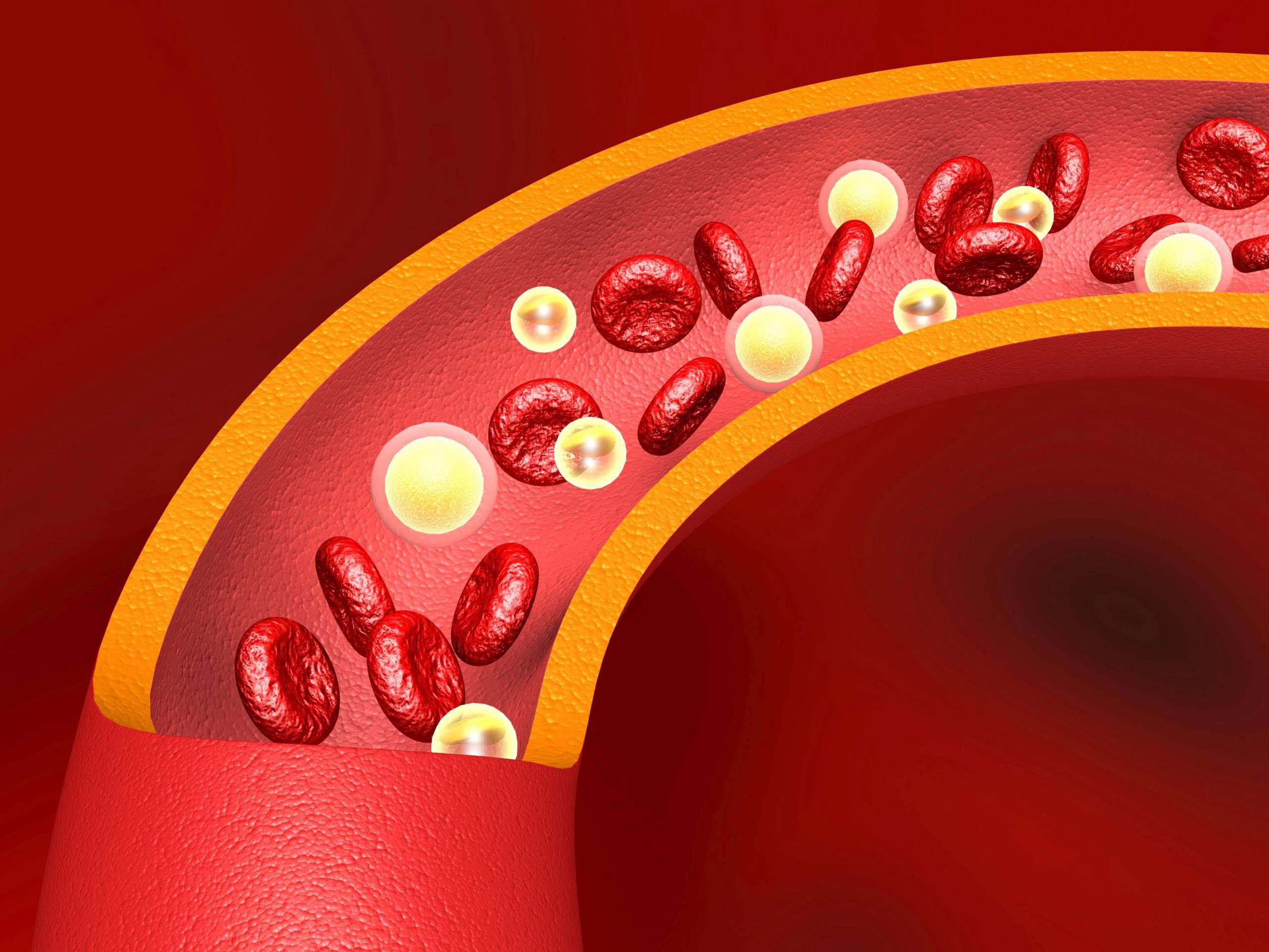 LDL-Cholesterin in den Arterien. 3D-Darstellung