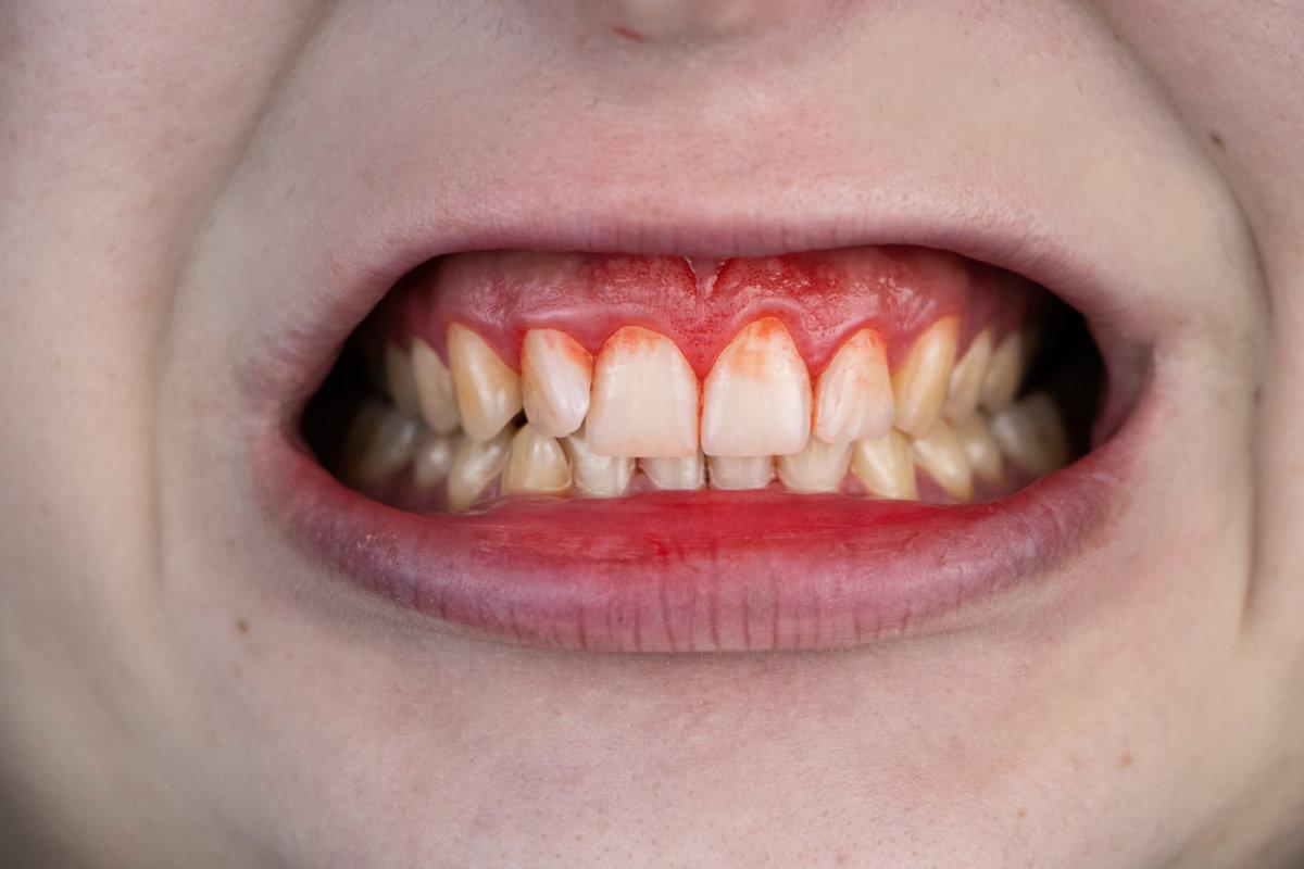 Zahnfleischbluten und Entzündungen aus nächster Nähe. Ein Mann, der von einem Zahnarzt untersucht wurde.
