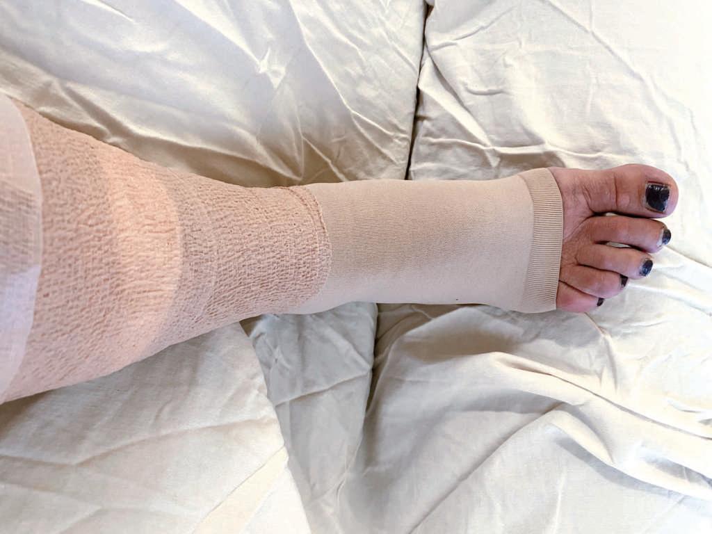 Bandagiertes Bein, das sich von einem chirurgischen Eingriff erholt