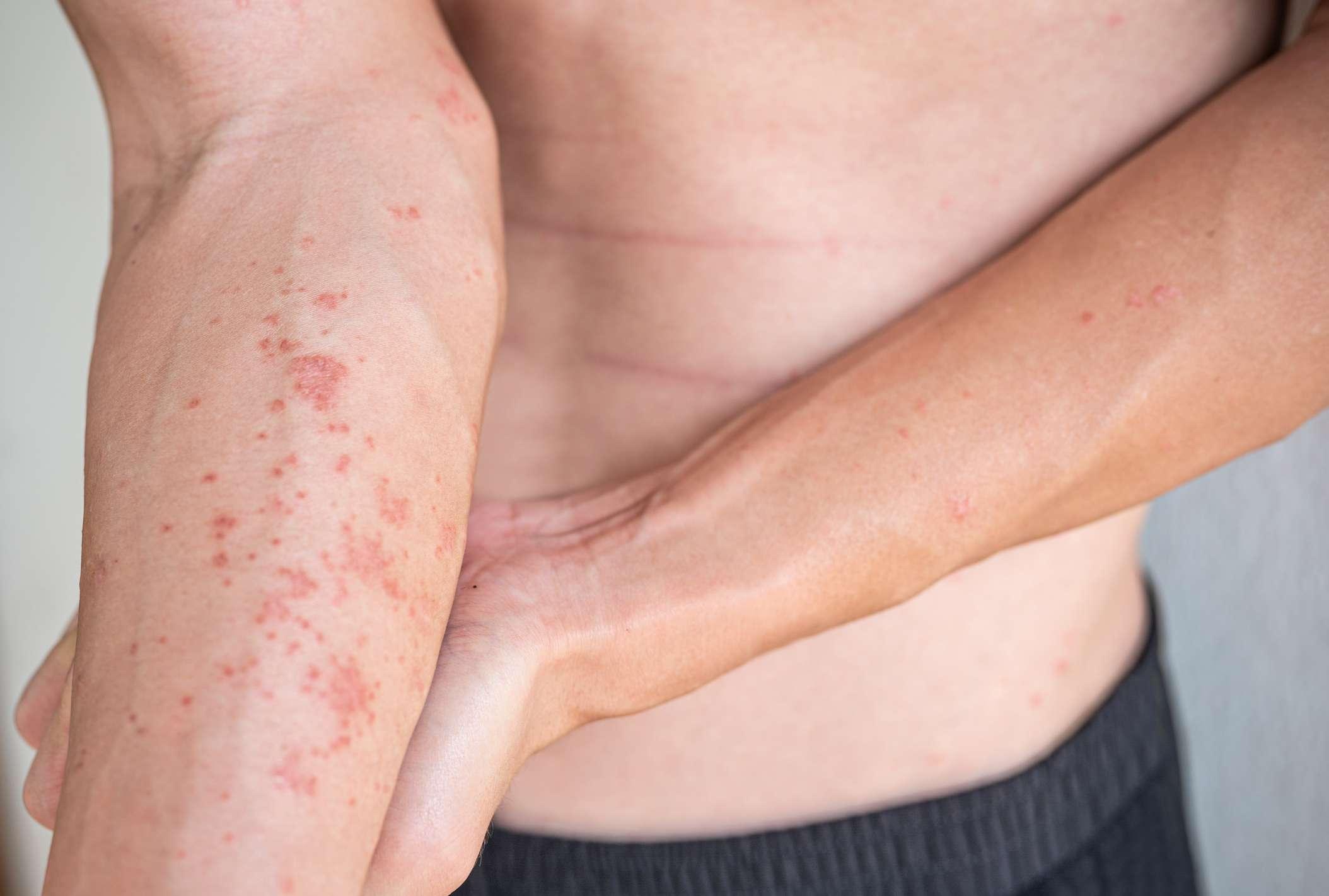 Arm eines Mannes, der Hautprobleme mit atopischer Dermatitis und trockener Haut um den Körper herum zeigt