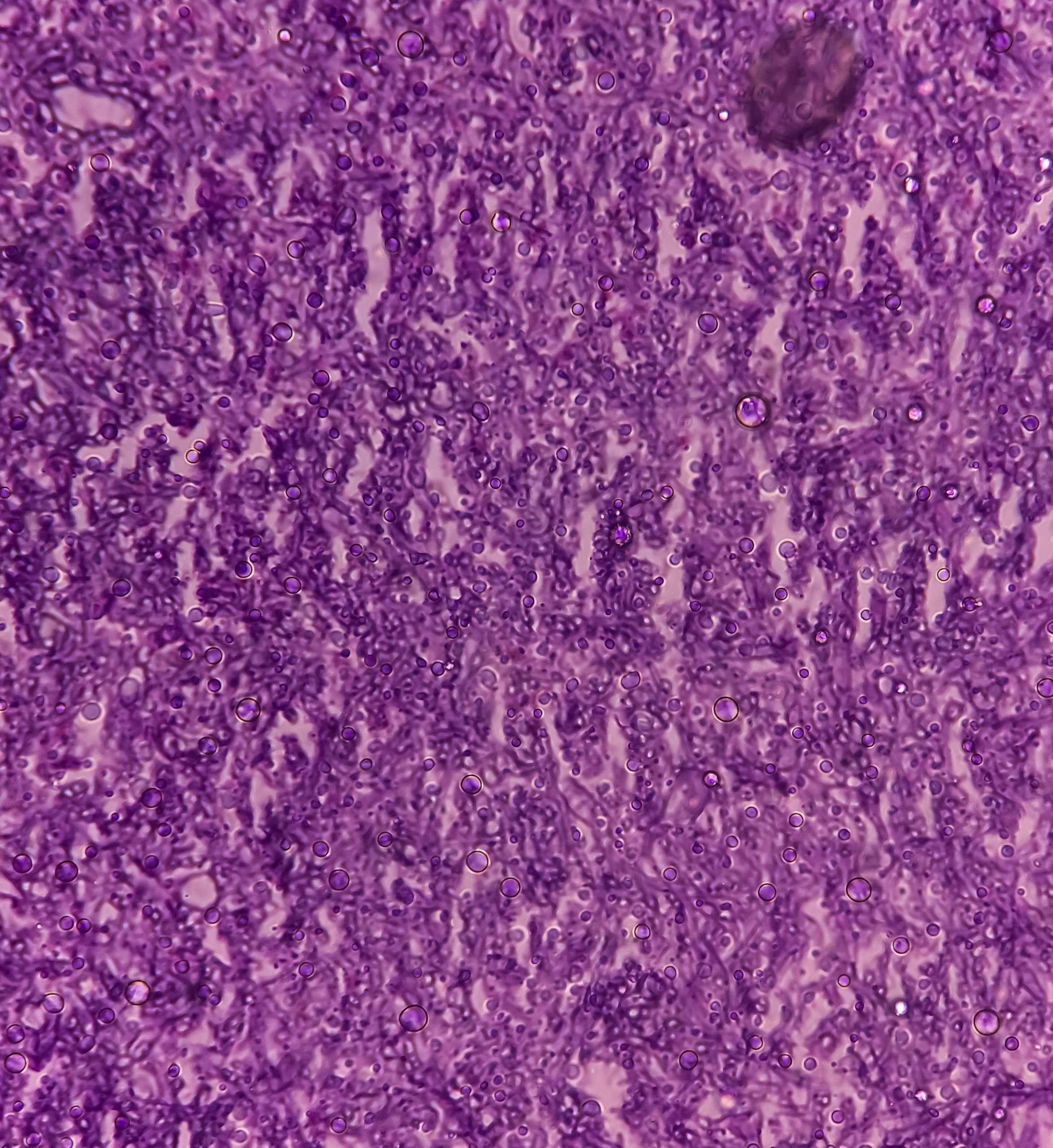 Pilzinfektion der Lunge, mikroskopisches Bild: Eine Hämatoxylin- und Eosin-Färbung zeigt Pilzhyphen einer histologischen Gewebeblockprobe.
