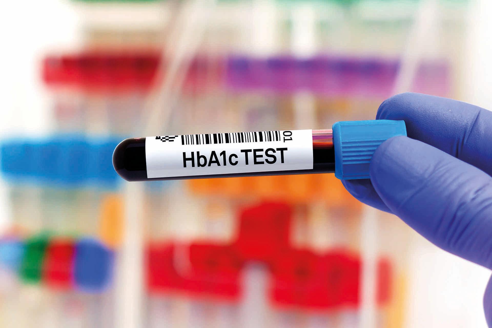 Blutprobe zur Untersuchung von HbA1c oder Hämoglobin A1c zum Nachweis von Diabetes