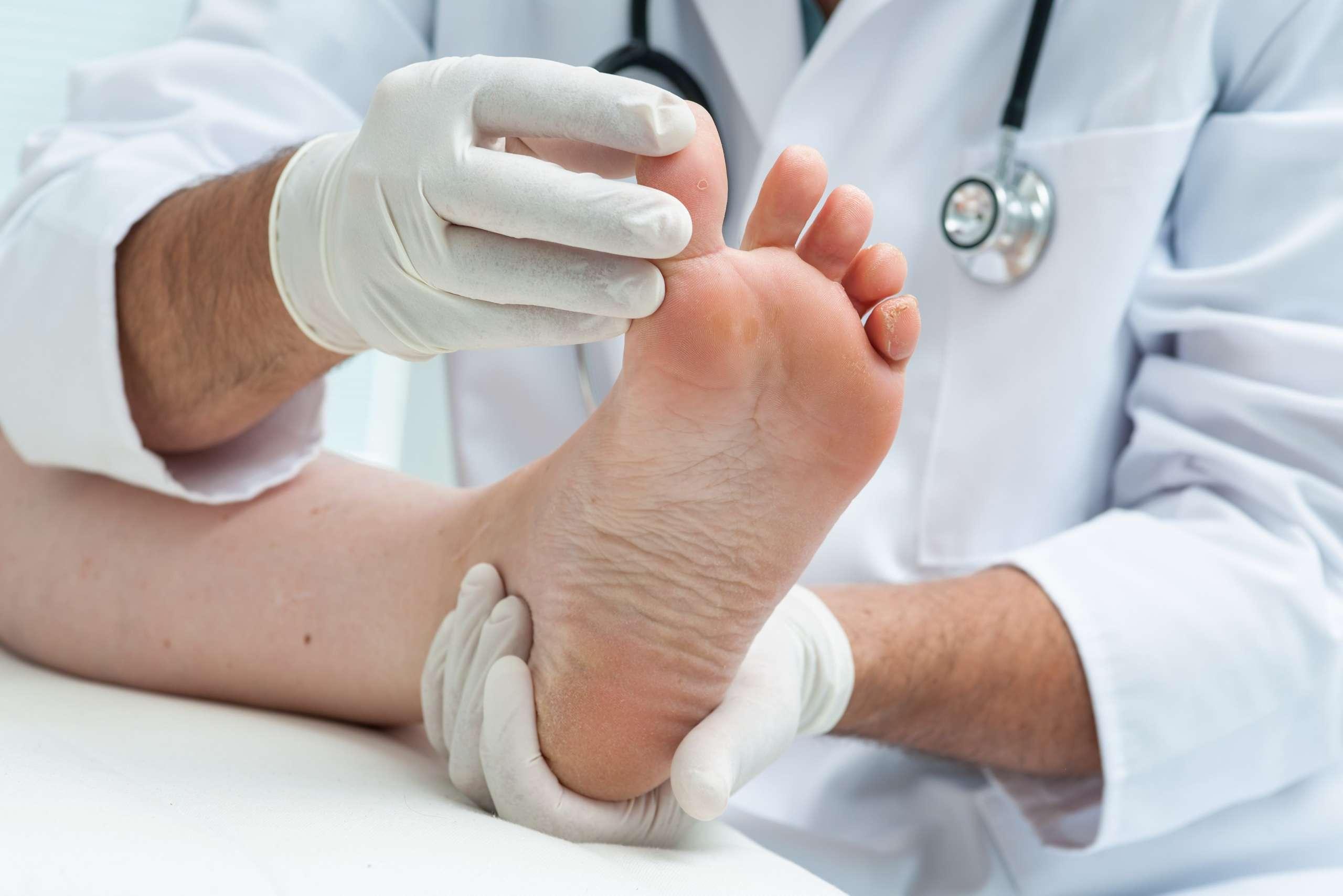 Arzt Dermatologe untersucht den Fuß auf das Vorhandensein von Fußpilz