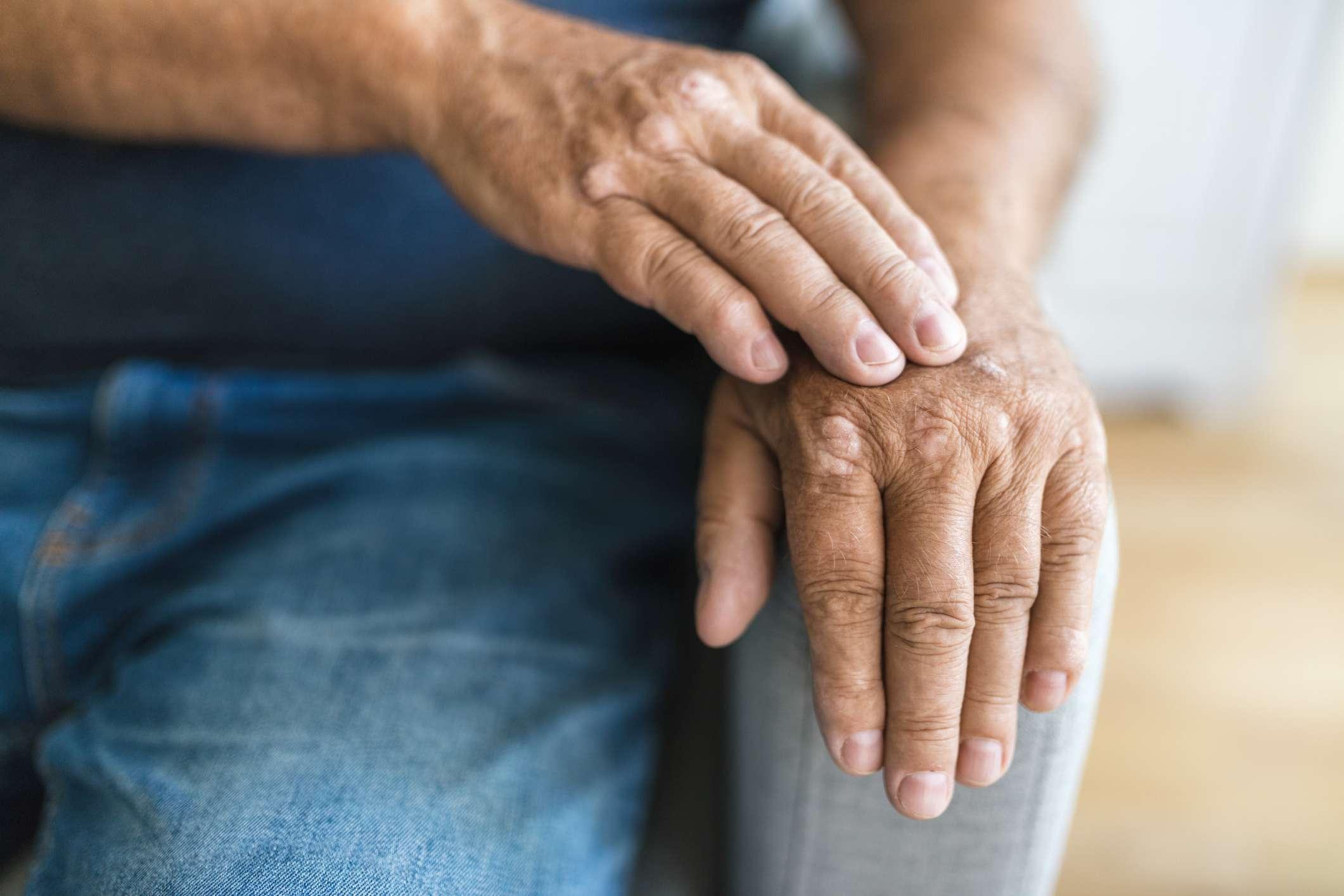 Älterer Mann, der an Psoriasis leidet, Nahaufnahme an den Händen