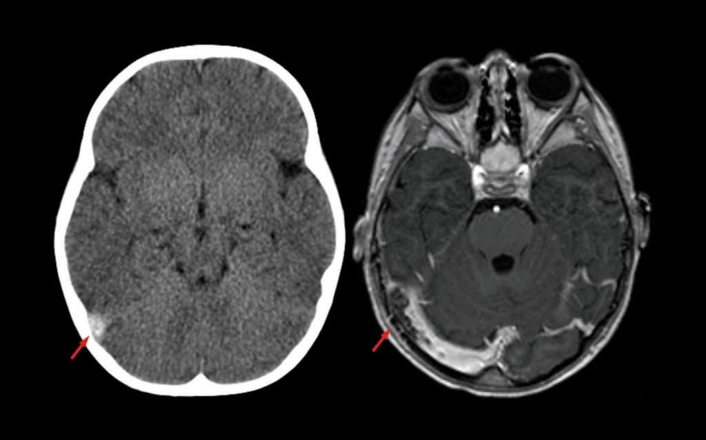 CT-Scan Sinusvenenthrombose
