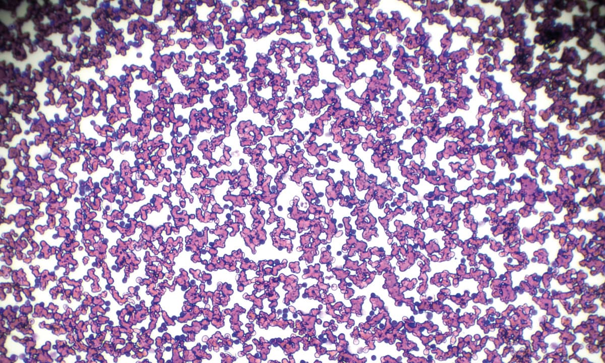 Chronic lymphocytic leukemia (CLL) blood smear under light microscopy