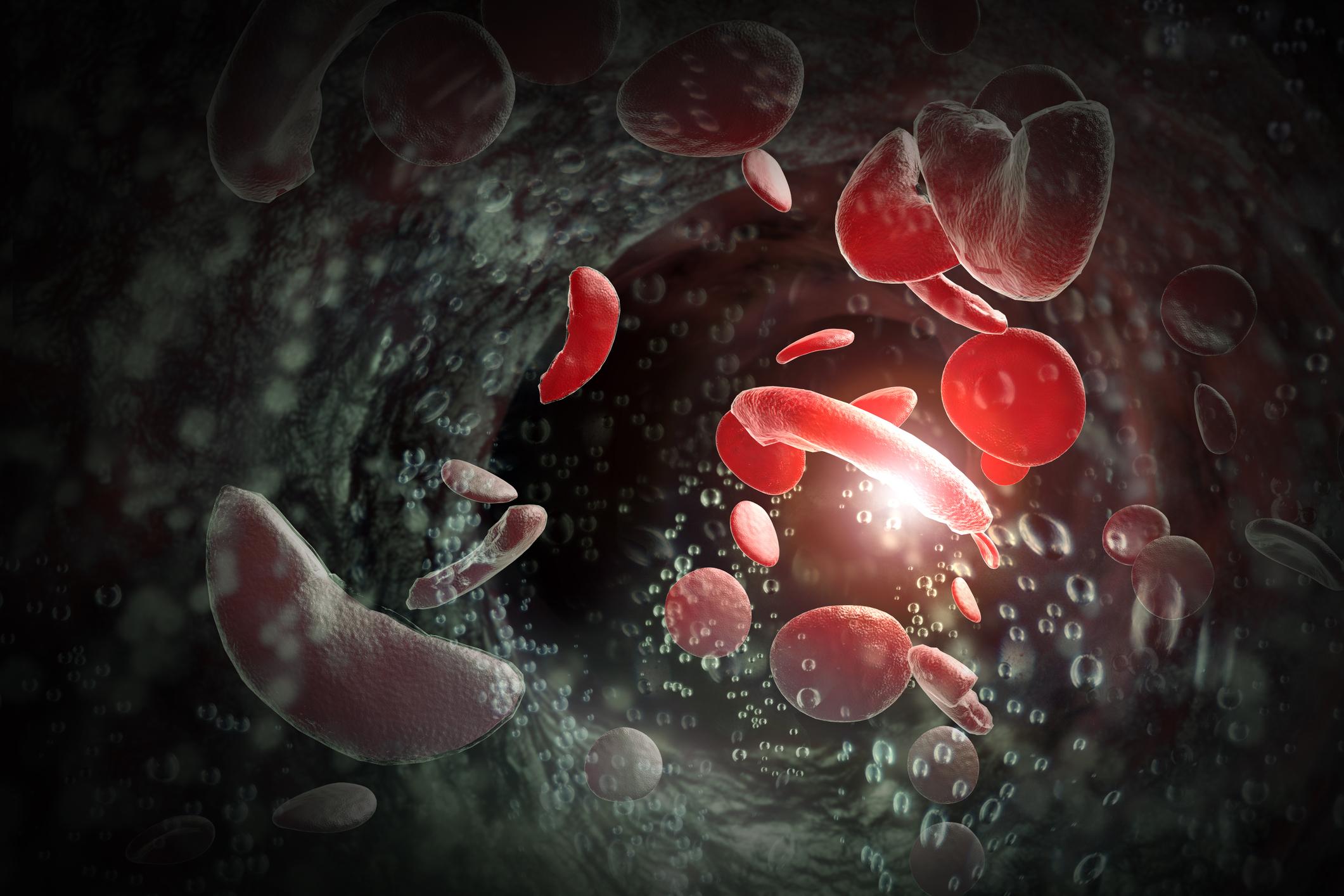 Blutkörperchen der Sichelzellenanämie (SCD) 3D-Darstellung