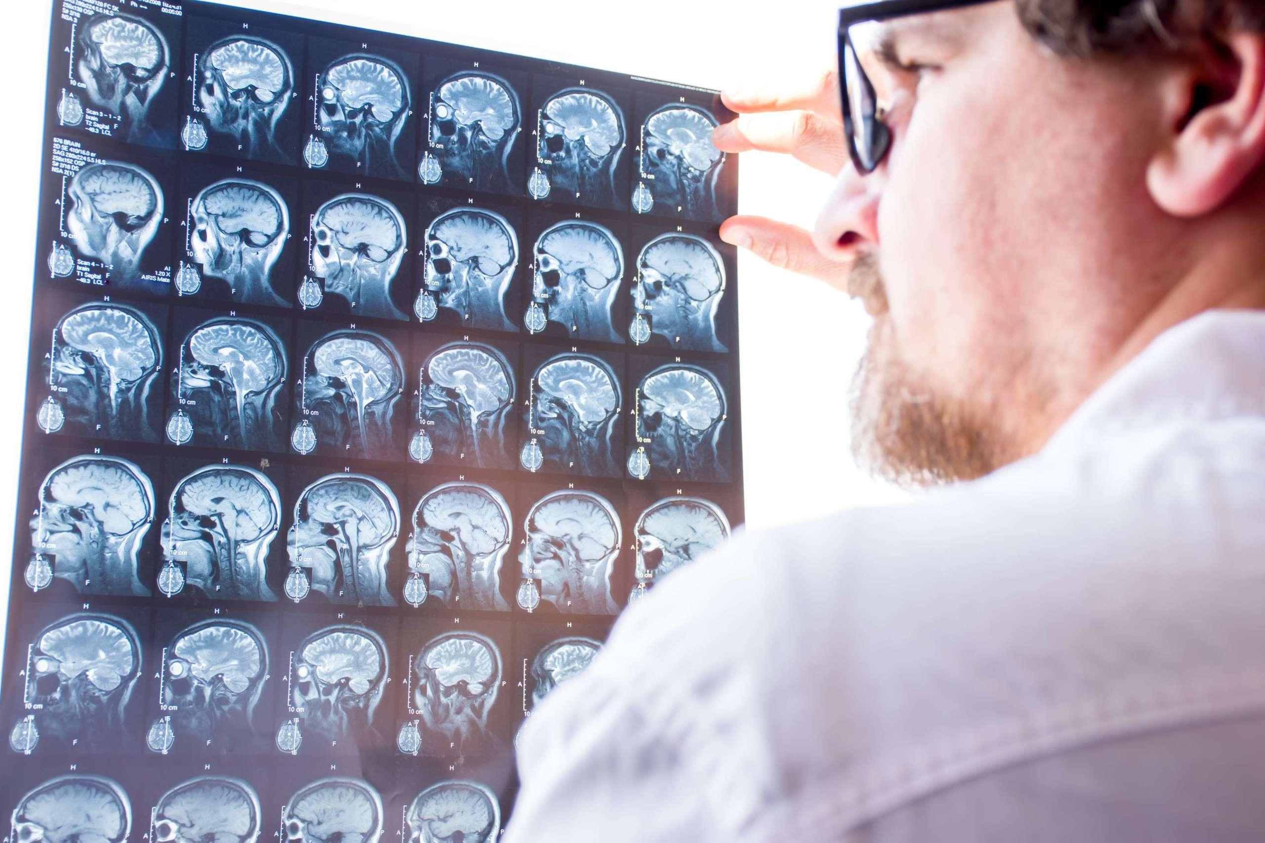 Ärzte bewerten die Ergebnisse der Magnetresonanztomographie des Gehirns im Krankenhauskonzeptfoto. Der Neurologe mit Brille hält die Hand auf dem Glas des Negatoskop-MRT-Scans und untersucht die Struktur des Gehirngewebes