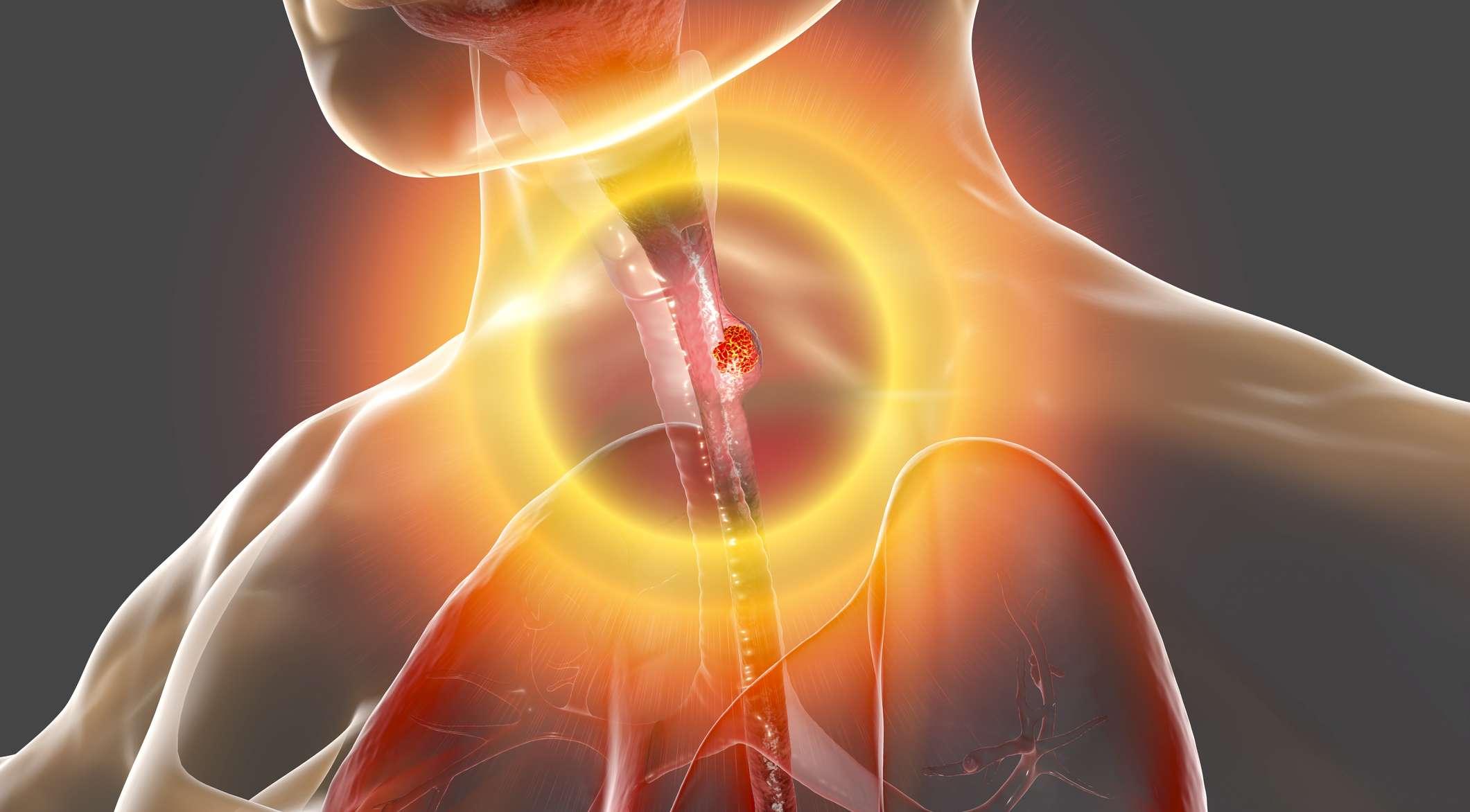 Speiseröhrenkrebs, 3D-Darstellung, die einen bösartigen Tumor in der menschlichen Speiseröhre zeigt