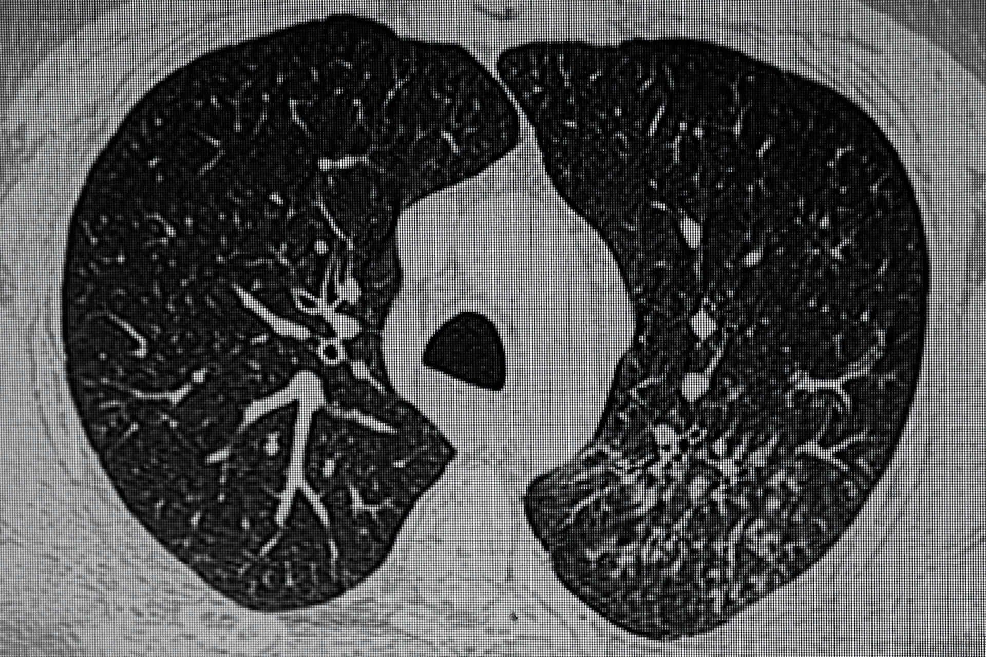 Lungentuberkulose CAT (Computer-Axial-Tomographie) Scan.