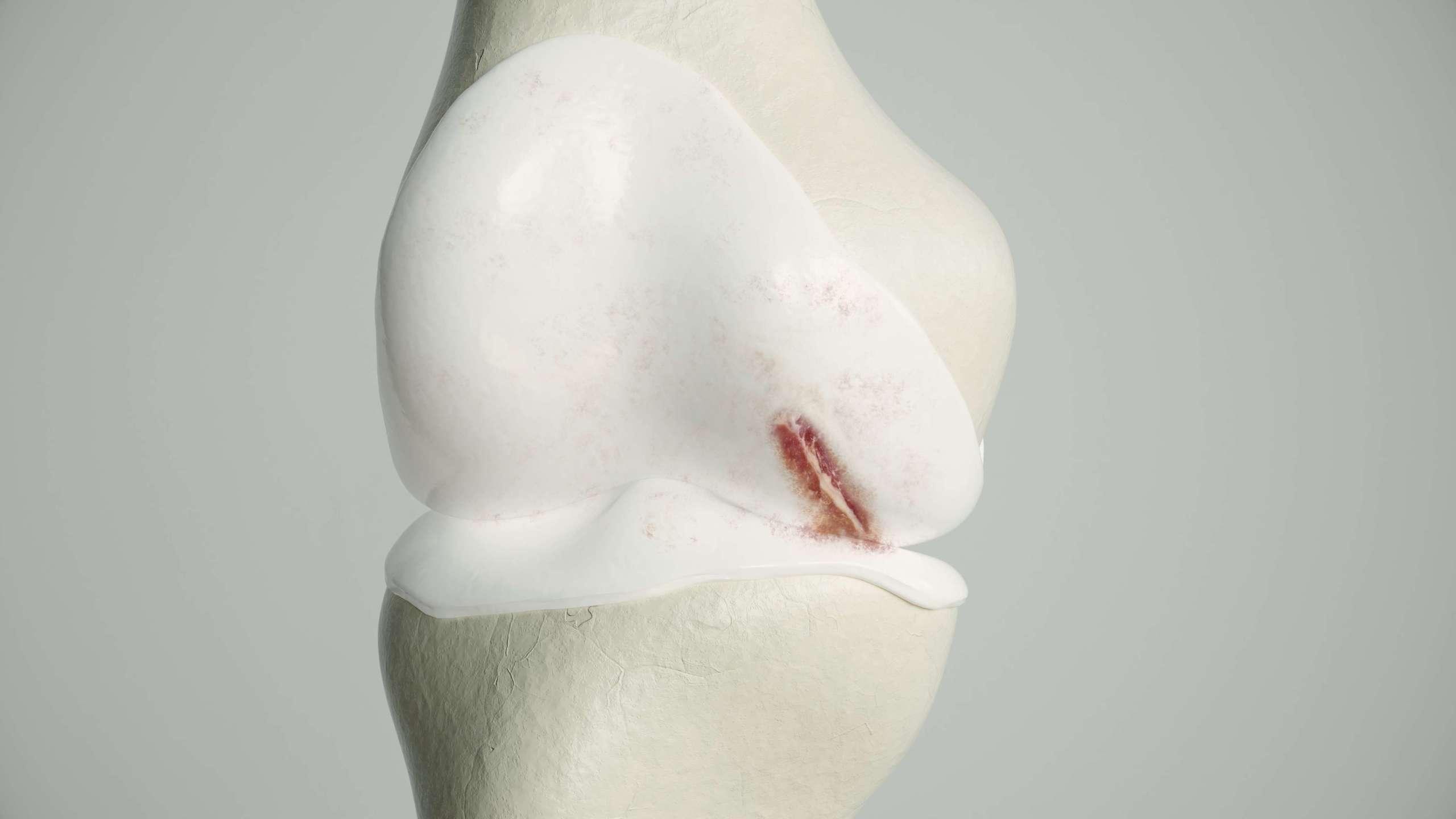 Leichte Arthrose am Kniegelenk - 3D-Rendering