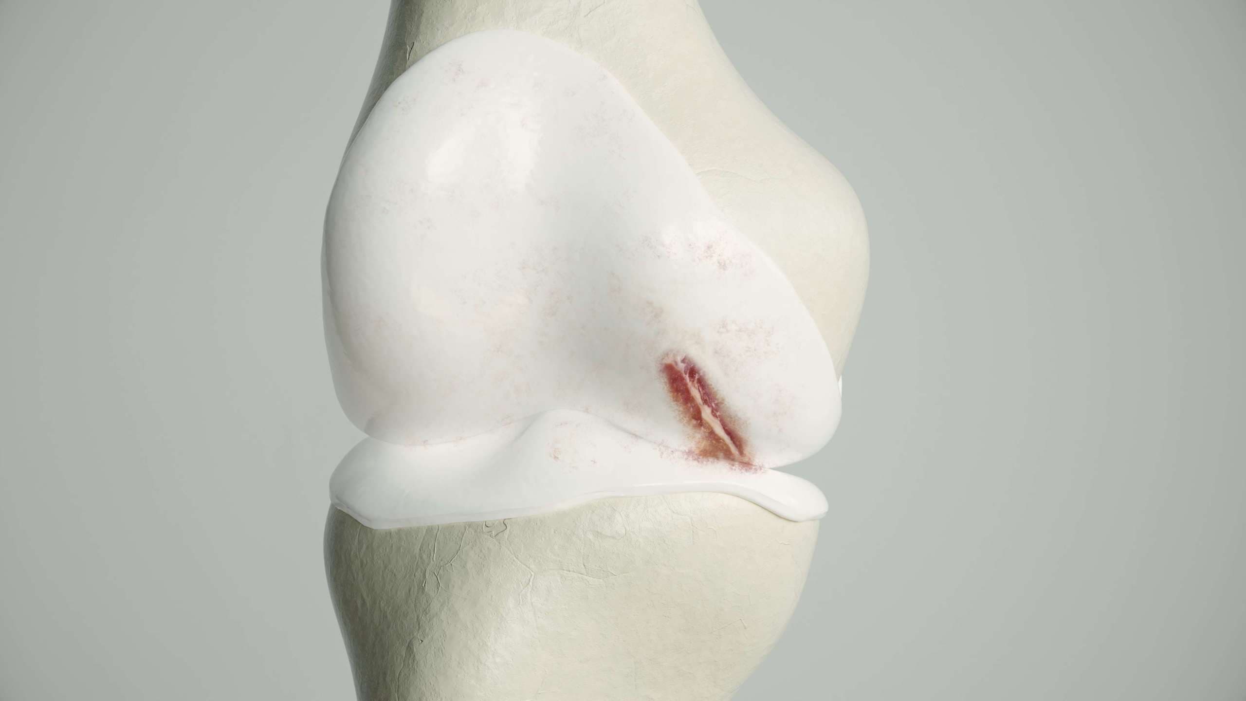 Leichte Arthrose am Kniegelenk - 3D-Rendering