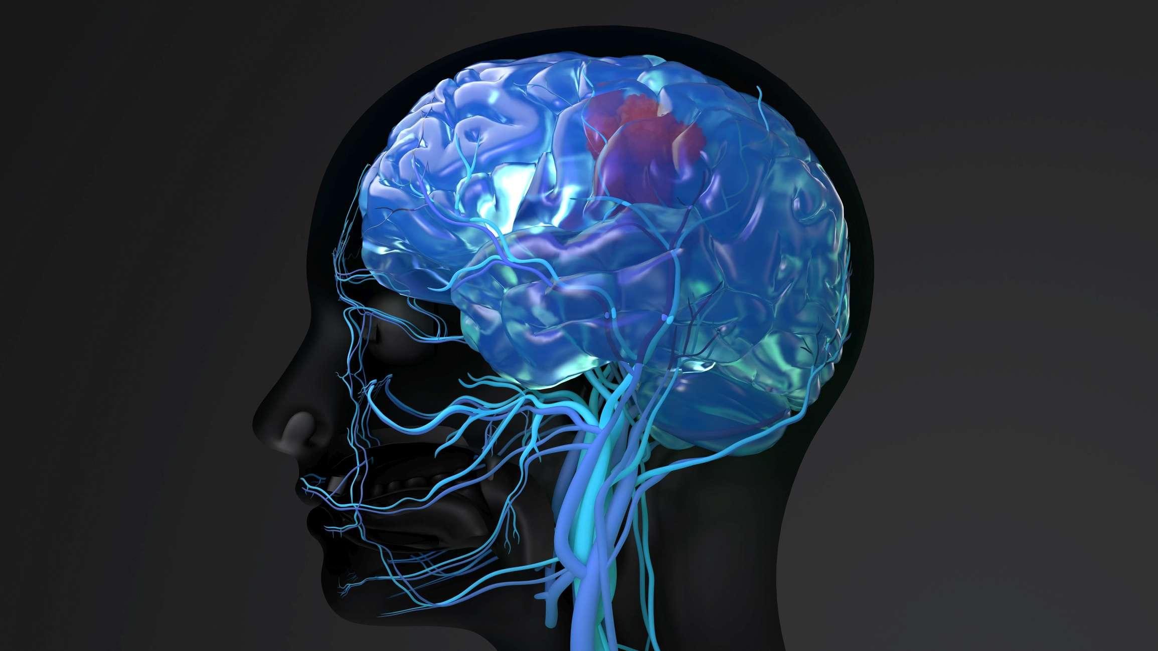Hirntumor, Kopf mit Tumor im Gehirn mit Blutgefäßen, 3D-Darstellung