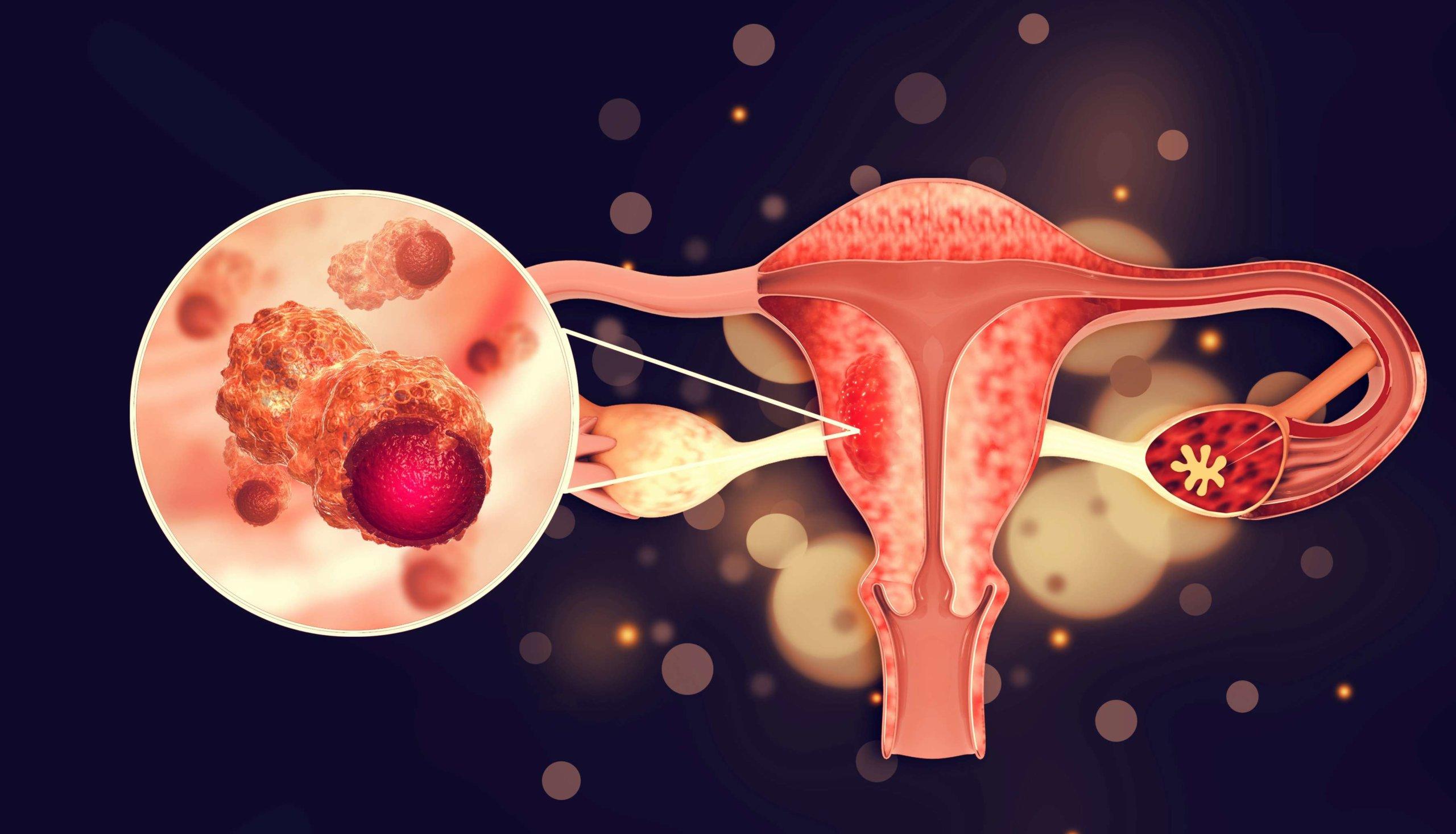 Erkrankungen des weiblichen Fortpflanzungssystems. Gebärmutterkrebs und bösartiger Tumor des Endometriums als uterines medizinisches Konzept. 3D-Darstellung