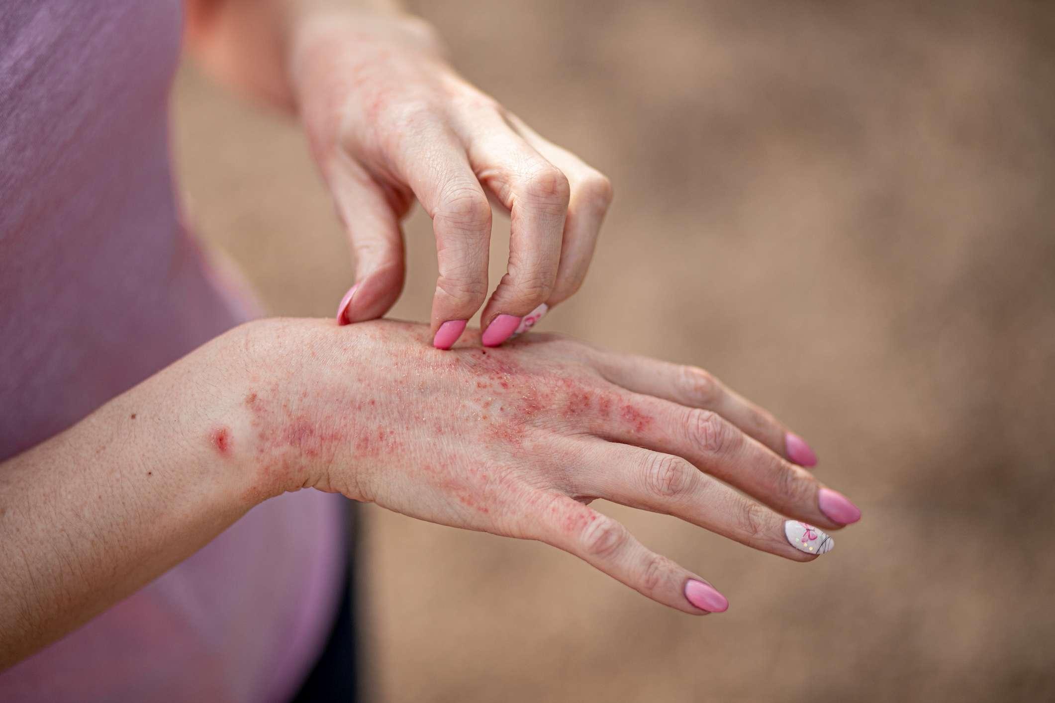 Ekzem Dermatitis an Händen und Füßen. rote Flecken auf der Haut. trockene HautDas Konzept Dermatologie, Behandlung von Pilzen. Frau kratzt sich an der Hand