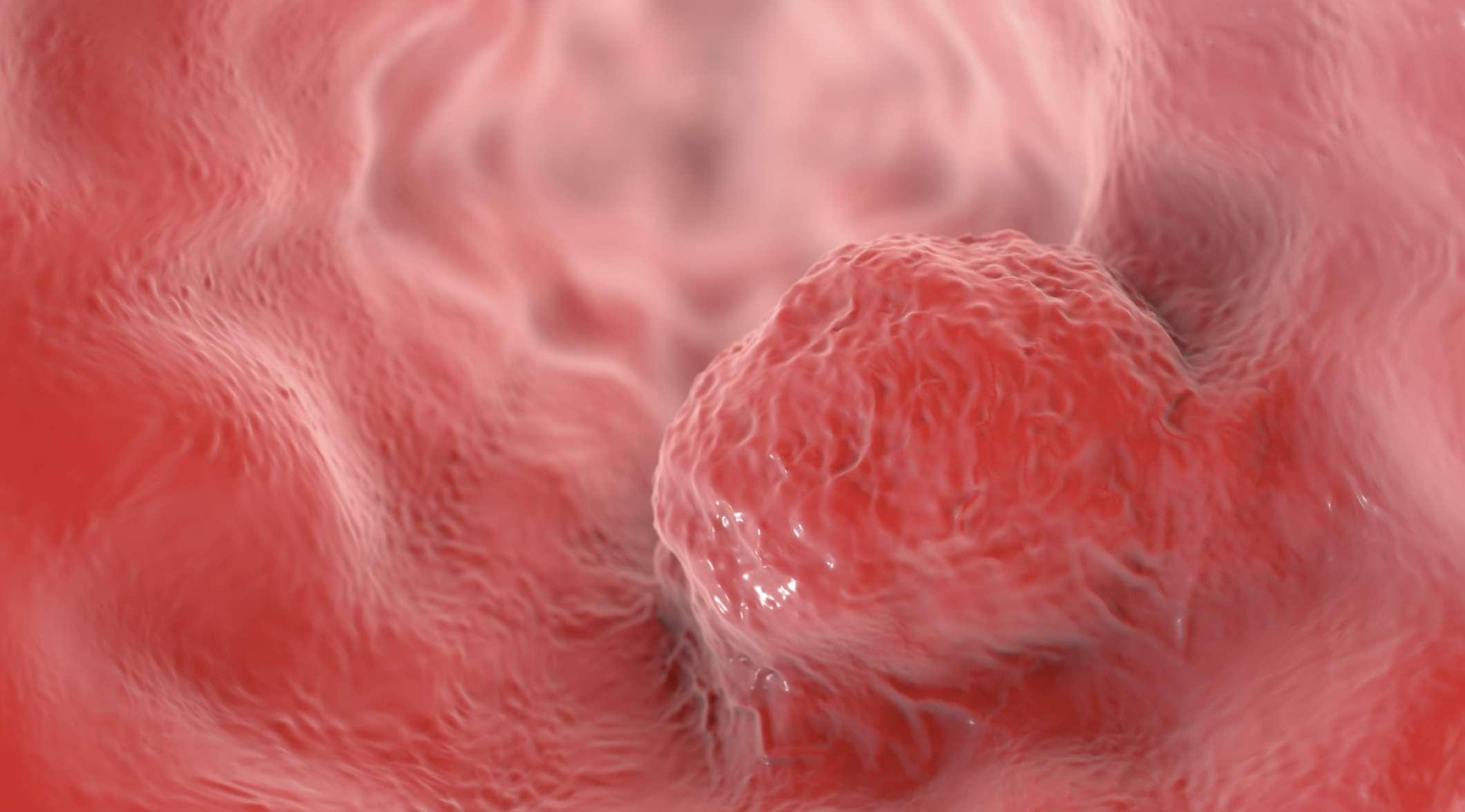 Speiseröhrenkrebs, 3D-Darstellung, die einen Tumor an der Wand der Speiseröhre zeigt